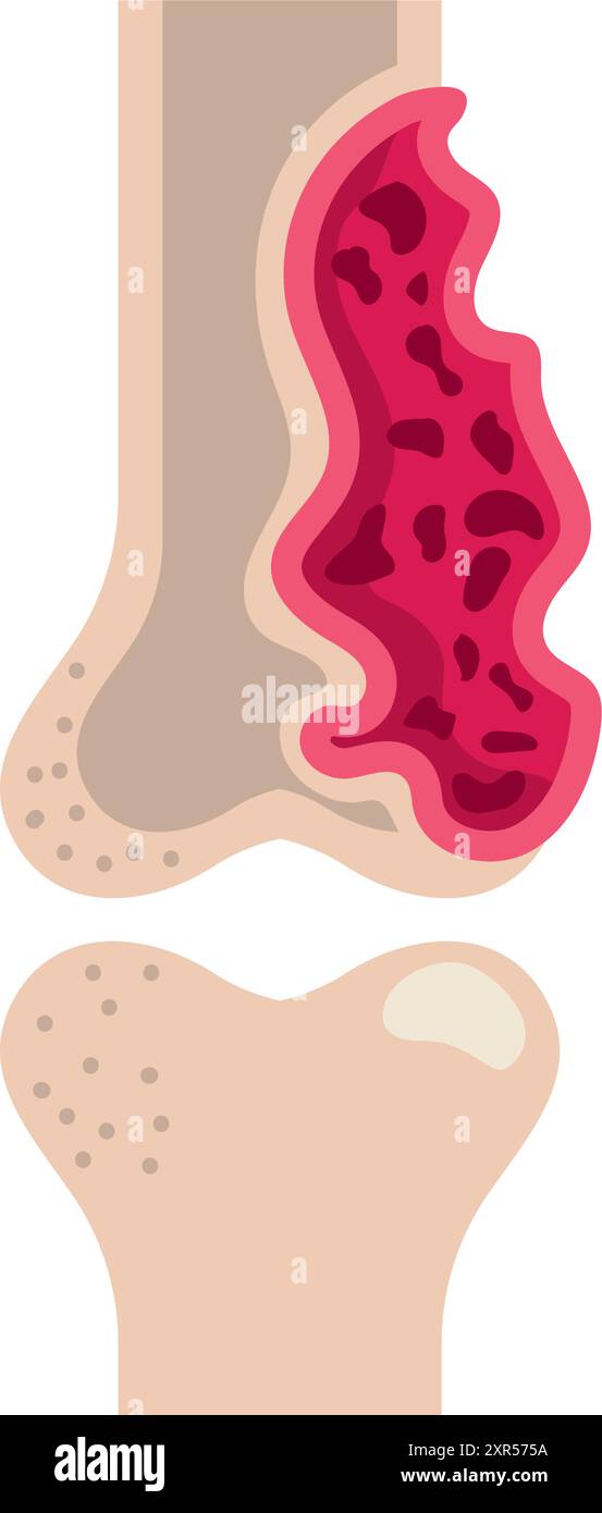 multiple myeloma bone marrow cancer Stock Vector Image & Art - Alamy