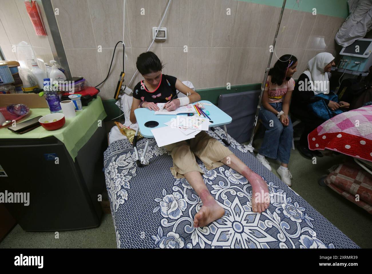 The two Palestinian girls, Rima and Dina Aql, are receiving treatment at Al-Aqsa Martyrs Hospital in Deir al-Balah, central Gaza Strip. The two Palestinian girls, Rima and Dina Aql, are receiving treatment at Al-Aqsa Martyrs Hospital in Deir al-Balah, central Gaza Strip, 11 August 2024. The family of the two girls was subjected to an Israeli attack that resulted in all eight 8 family members sustaining third-degree burns 70% to 80% however, the lack of necessary medical treatment for the burns led to the gradual death of 6 family members over the course of 10 days, while the two girls, Rima an Stock Photo