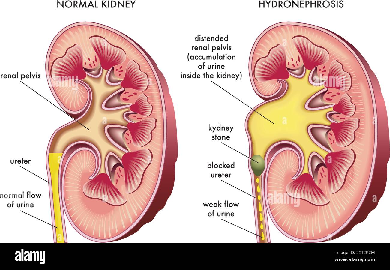 Medical illustration comparing a normal kidney to one affected by ...