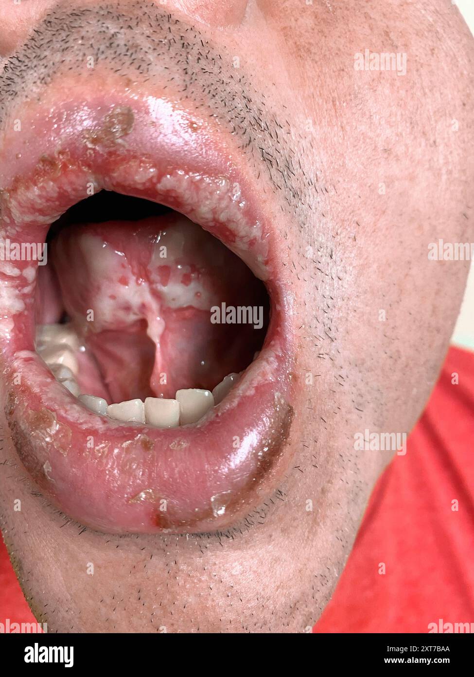 Oral Thrush in a Patient