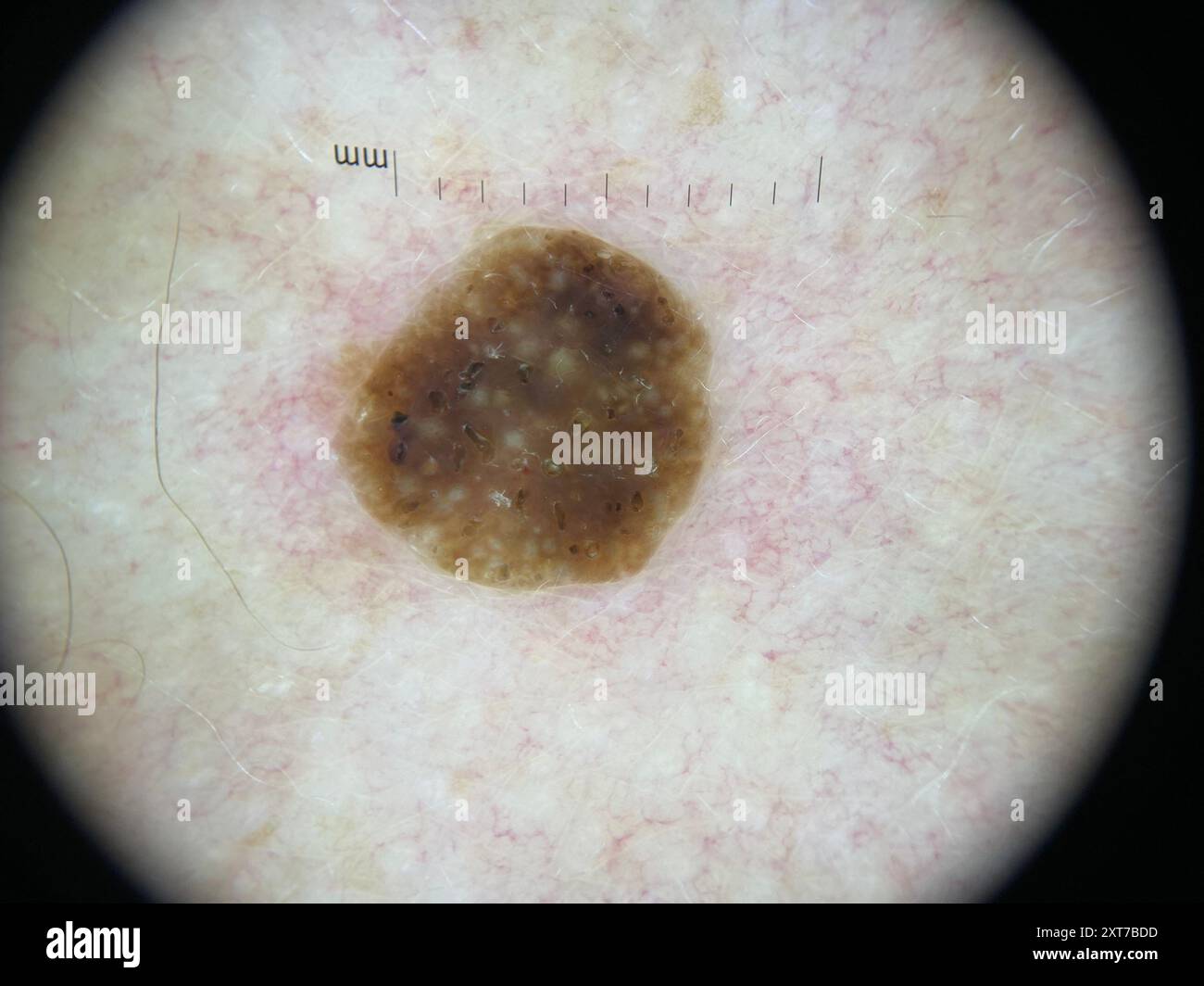 Dermatoscope image of a seborrheic keratosis on the back of a 68 year