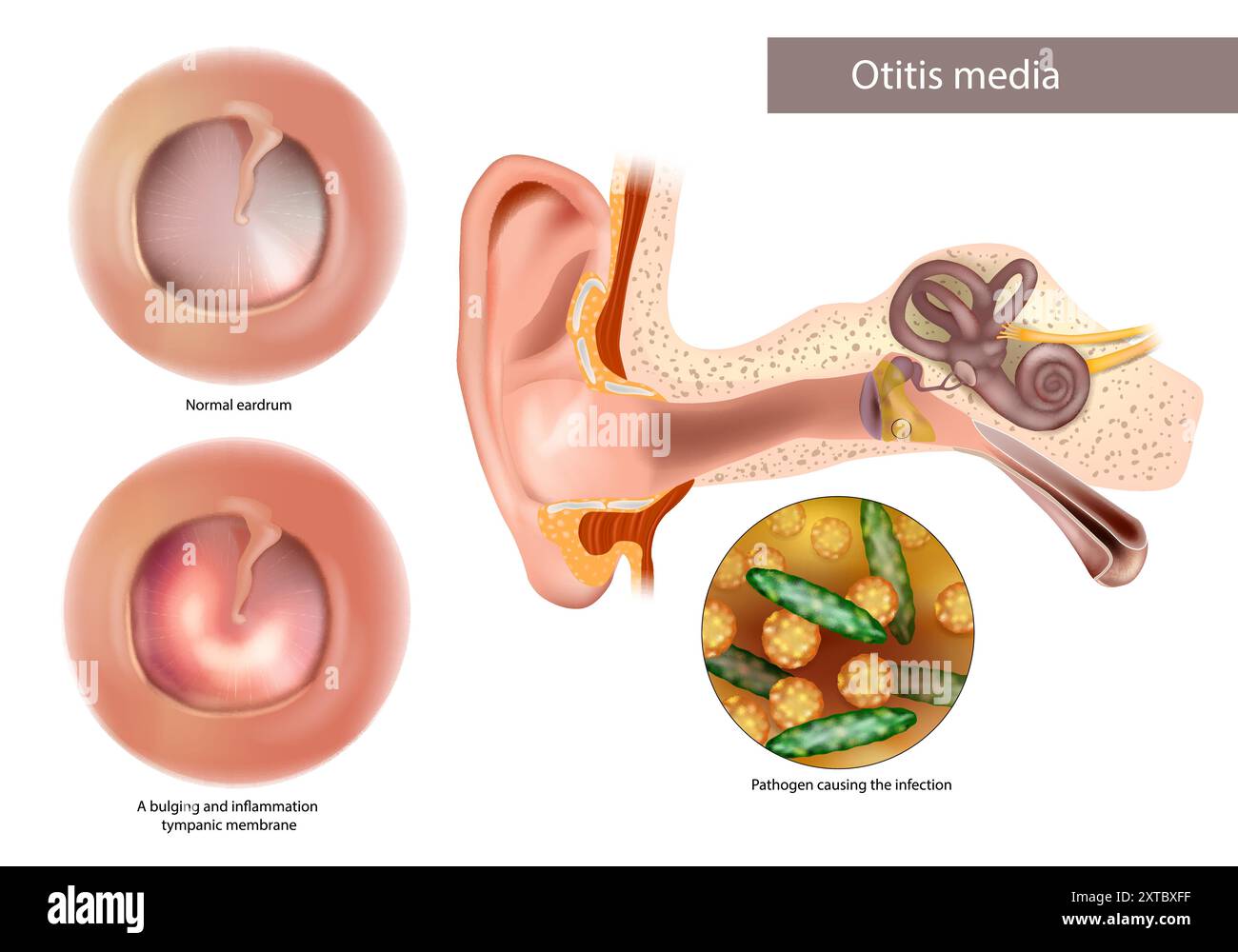 Otitis Media or Chronic Suppurative. Pathogen causing the infection. Normal eardrum and bulging and inflammation tympanic membrane. Stock Vector