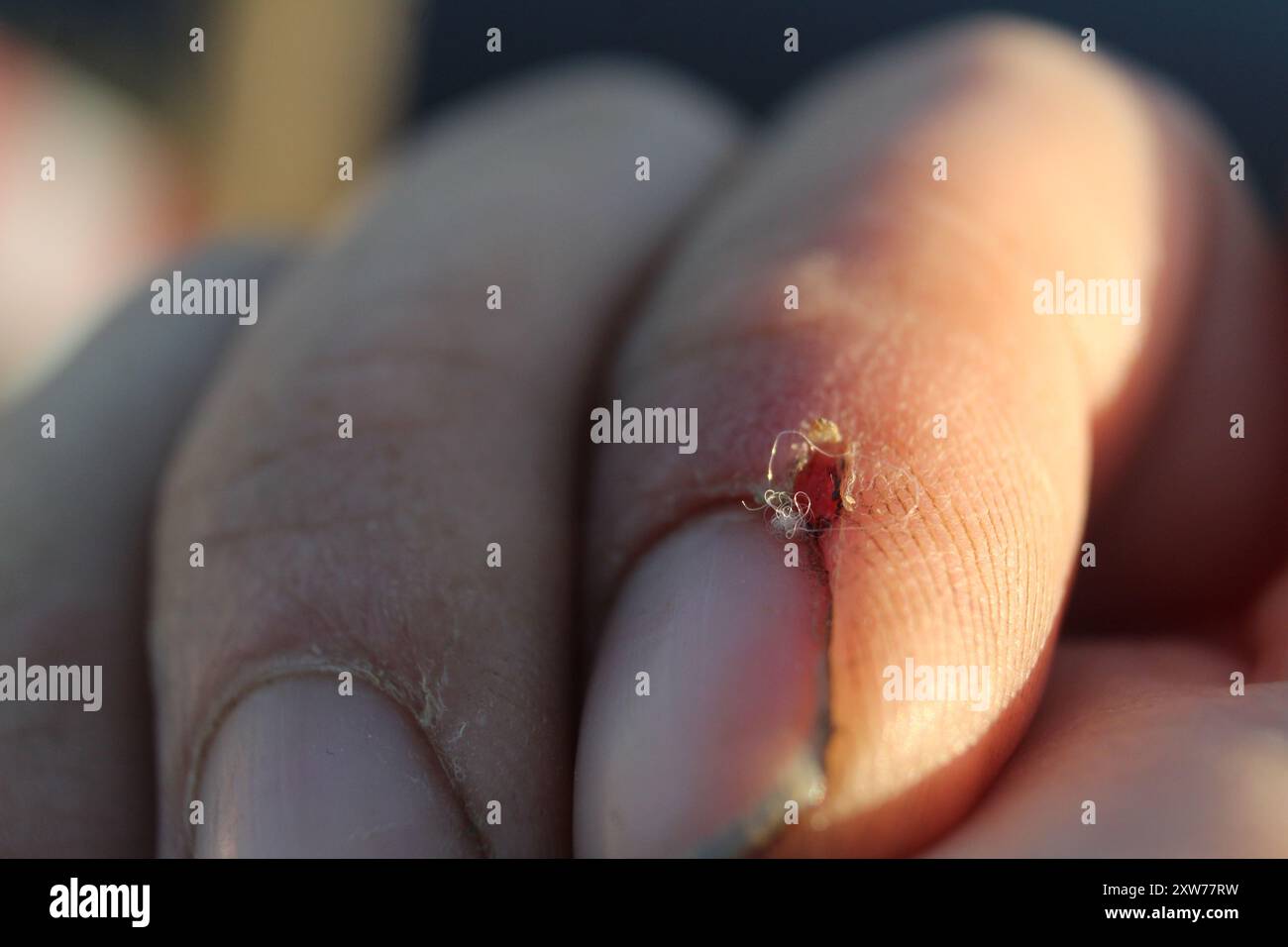 tear of the skin on the finger. Skin cuticle injuries on the index ...