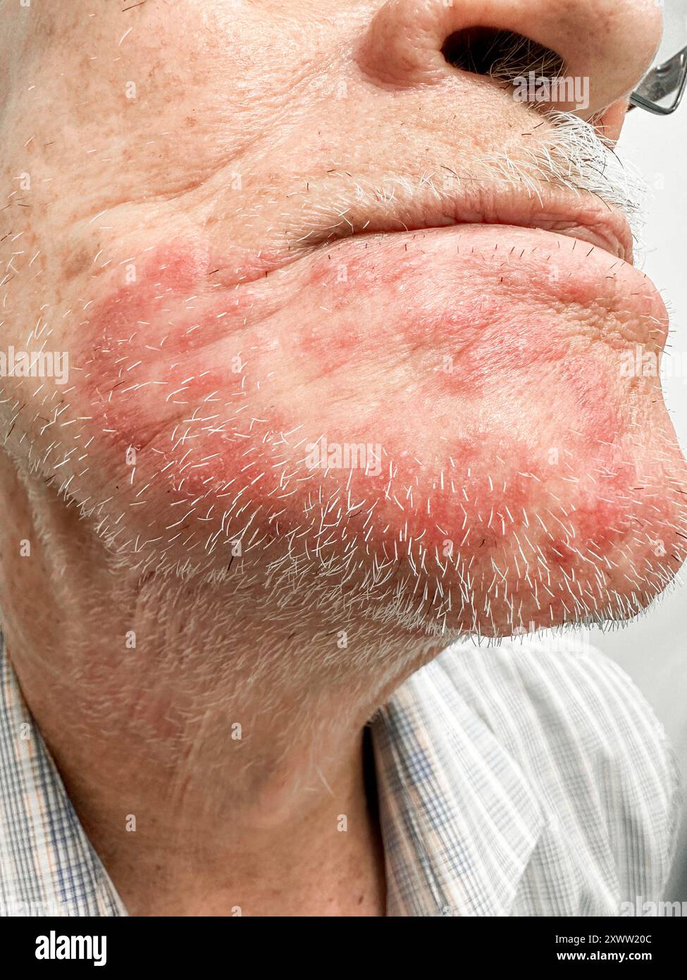 Ringworm infection on the chin of an elderly male Hispanic patient ...