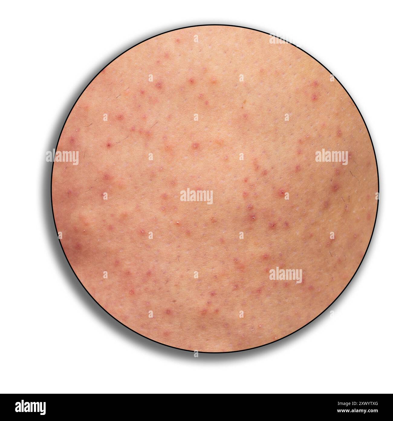 close-up in a magnification circle of woman's legs with keratosis ...