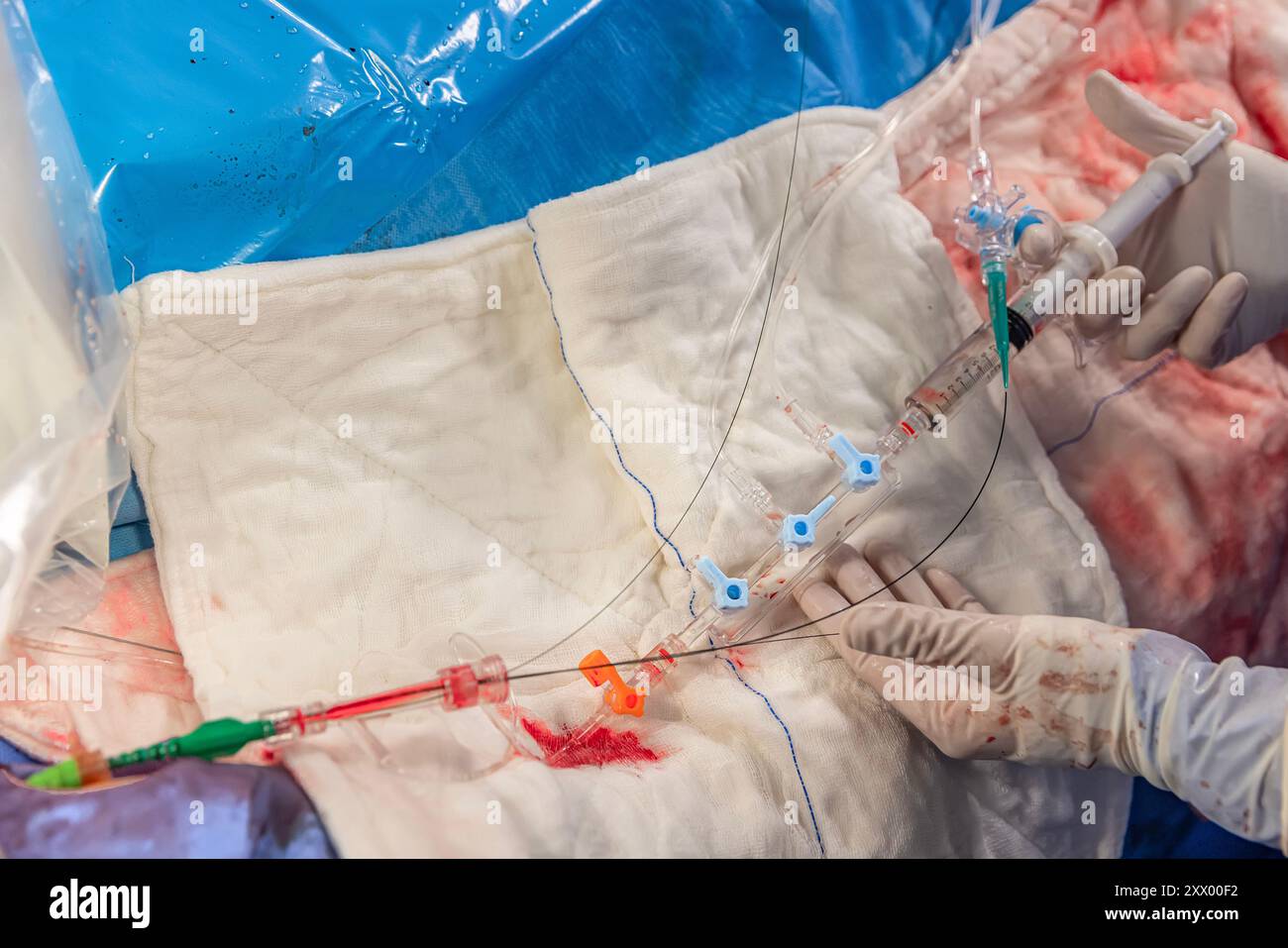 Heart stent placement process in operating room. Heart doctor inserting ...