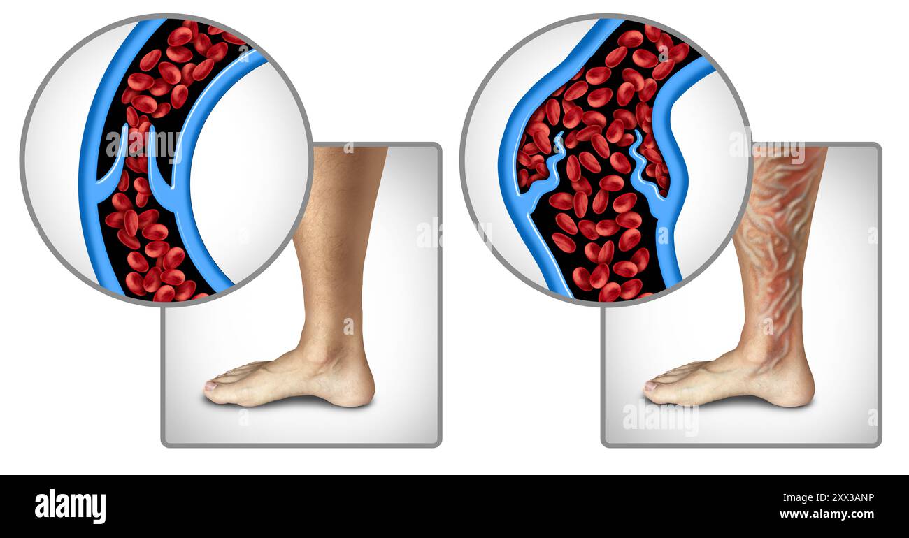 Your Legs Are Telling You Something Could This Vein Disorder Be The Culprit - scauotg