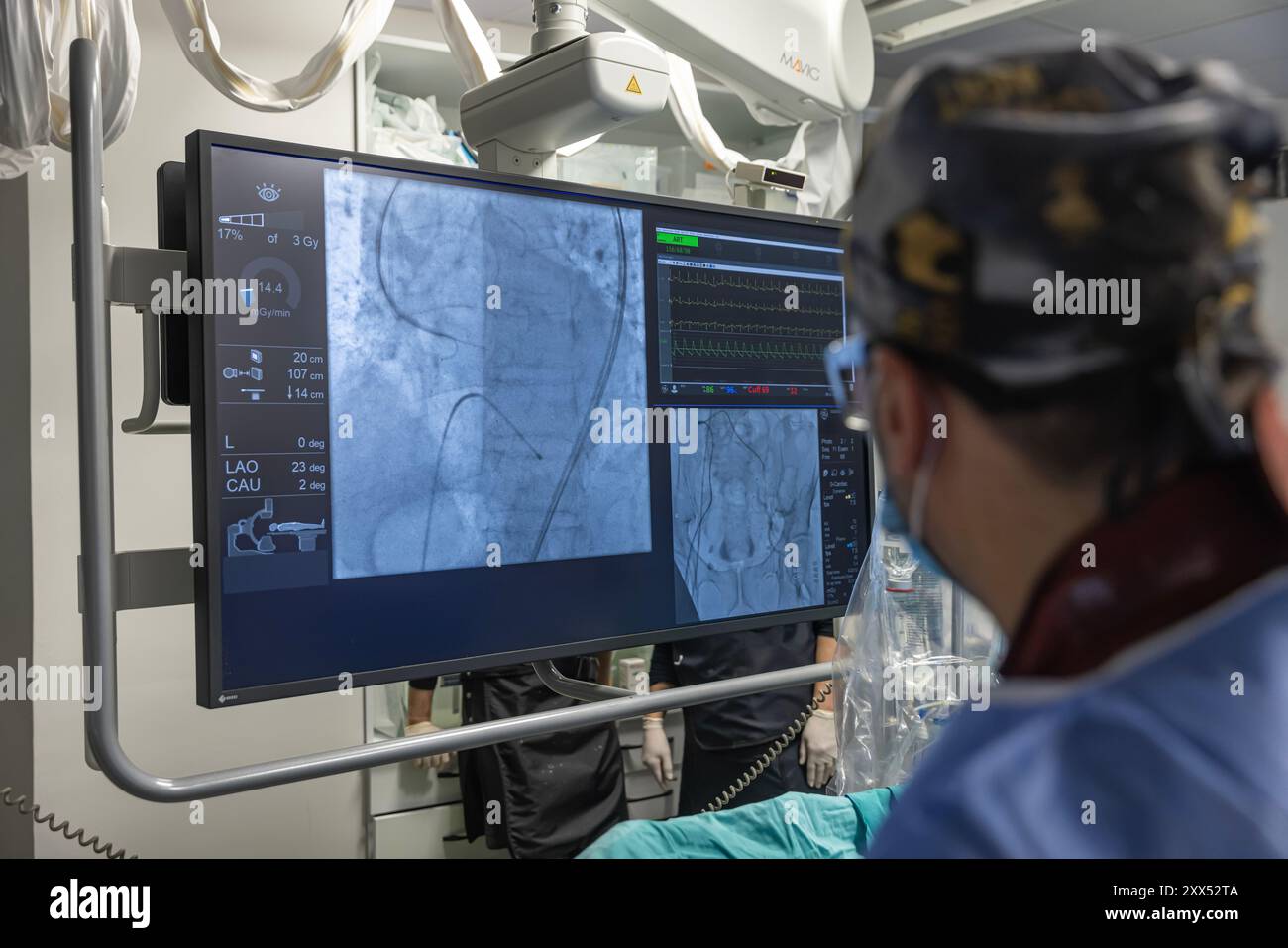 Balloon angioplasty x ray hi-res stock photography and images - Alamy