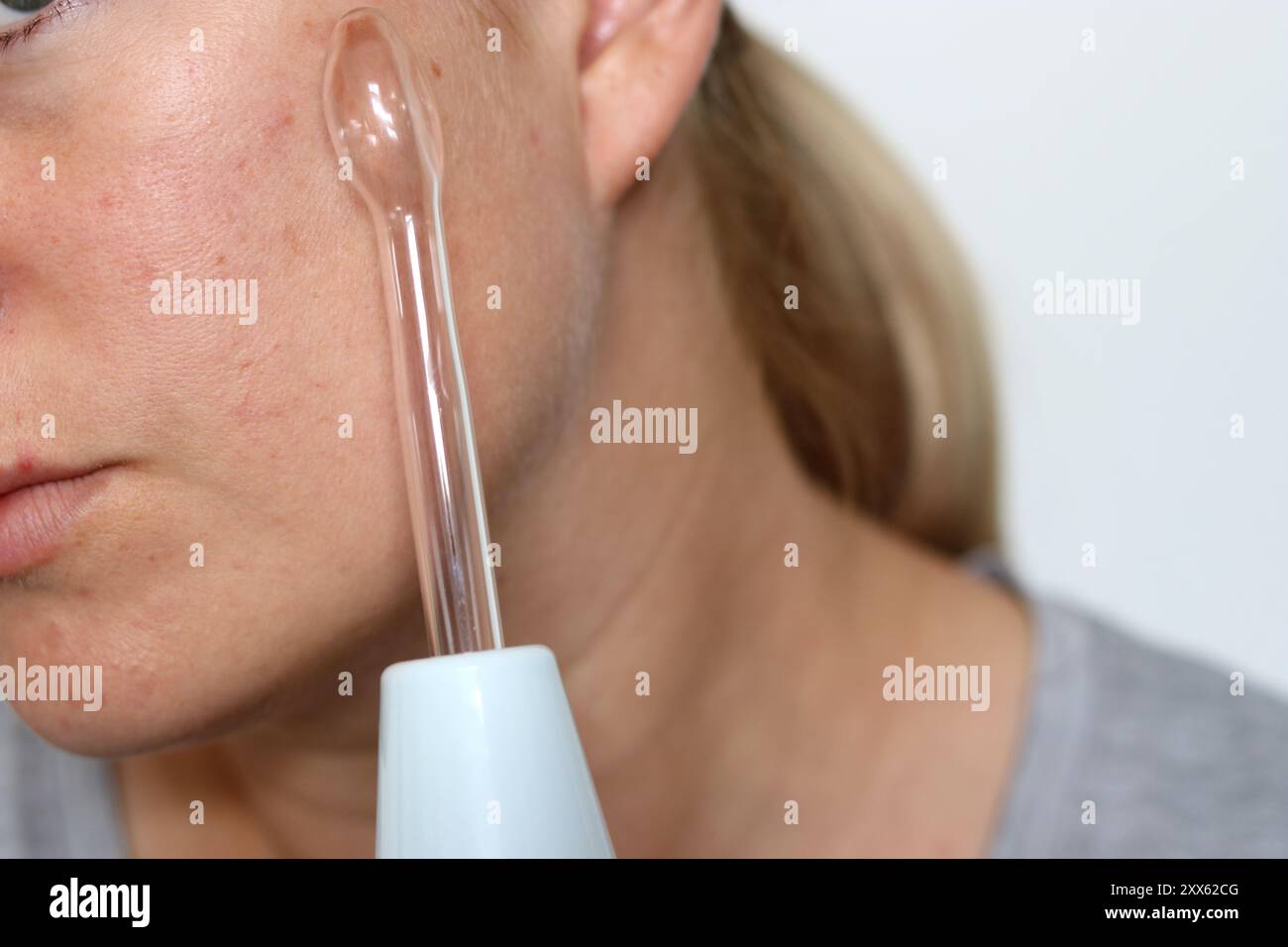 Close up of woman using a high frequency darsonval device on acne skin Stock Photo