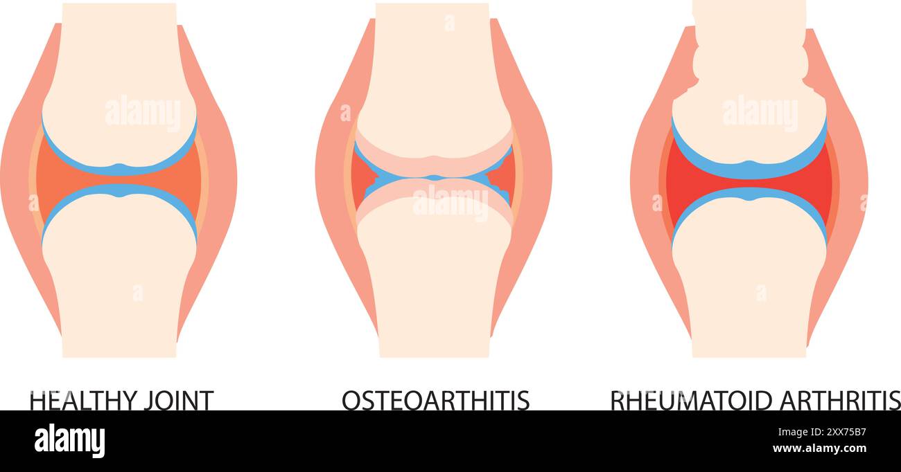 Joint anatomy, osteoarthritis and rheumatoid arthritis infographic with ...