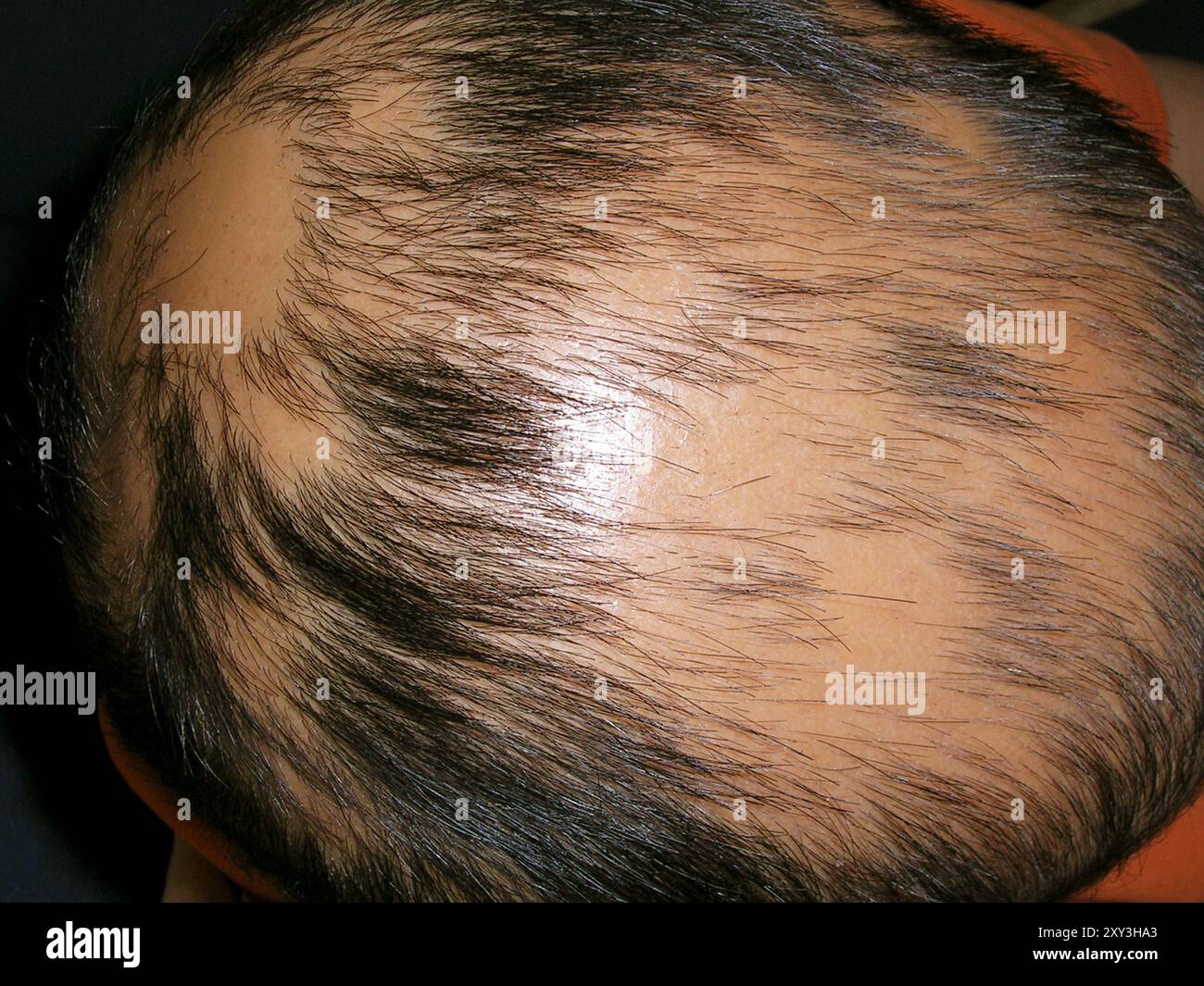 Bald spots on the head of a 10 year old Asian boy with alopecia areata ...