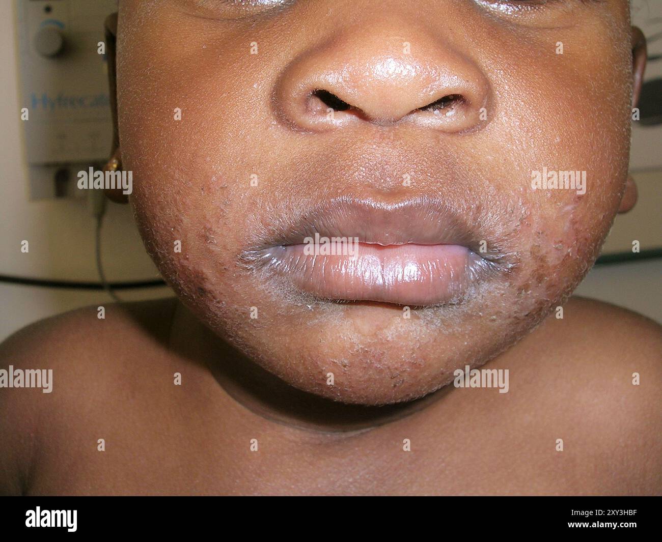 Atopic dermatitis on an African-American child's face. Atopic ...