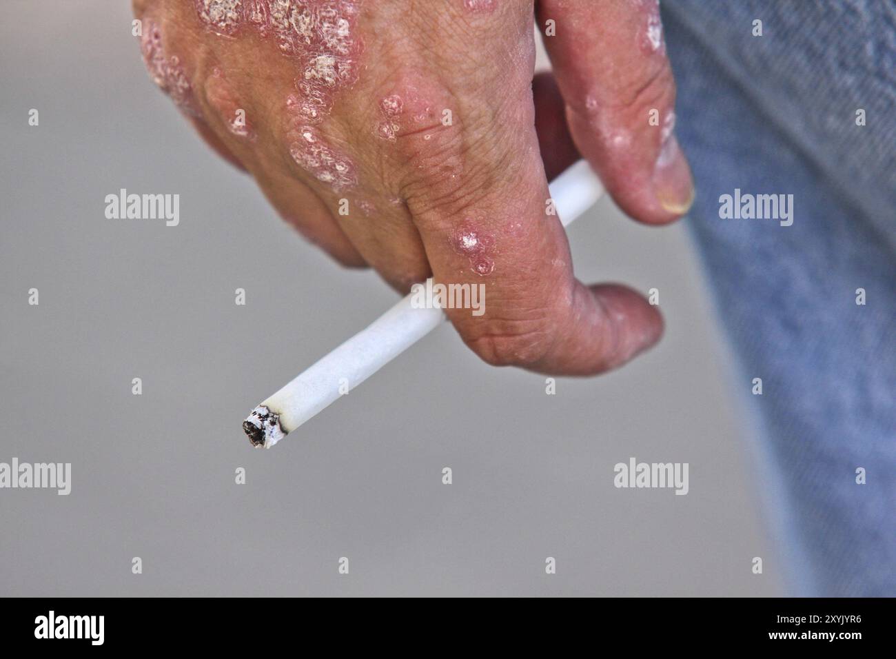 holding cigarette between fingers Person with psoriasis on it's hand, holding a lit cigarette between fingers,  closeup Stock Photo