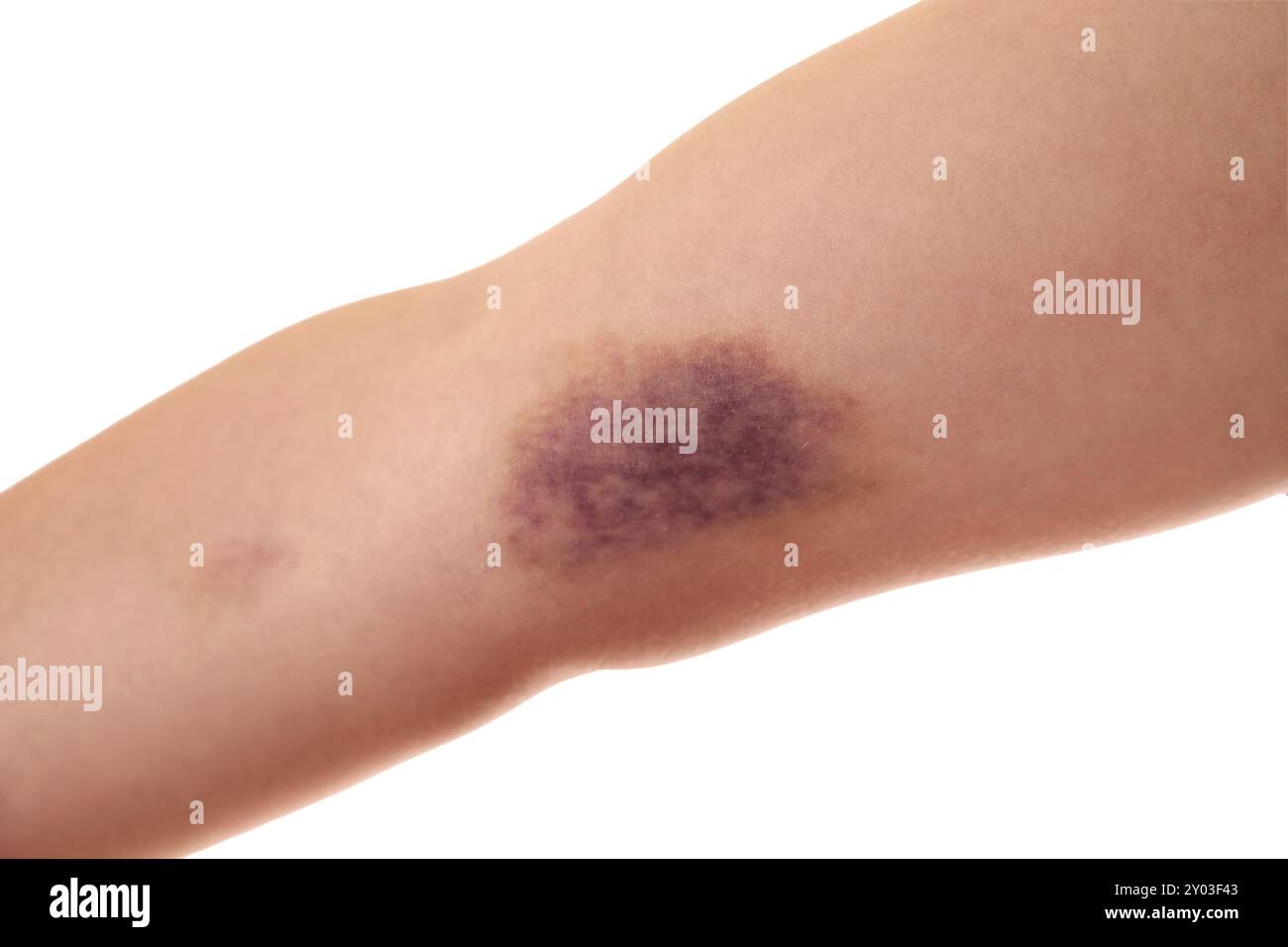 Woman with bruise on arm against white background, closeup Stock Photo