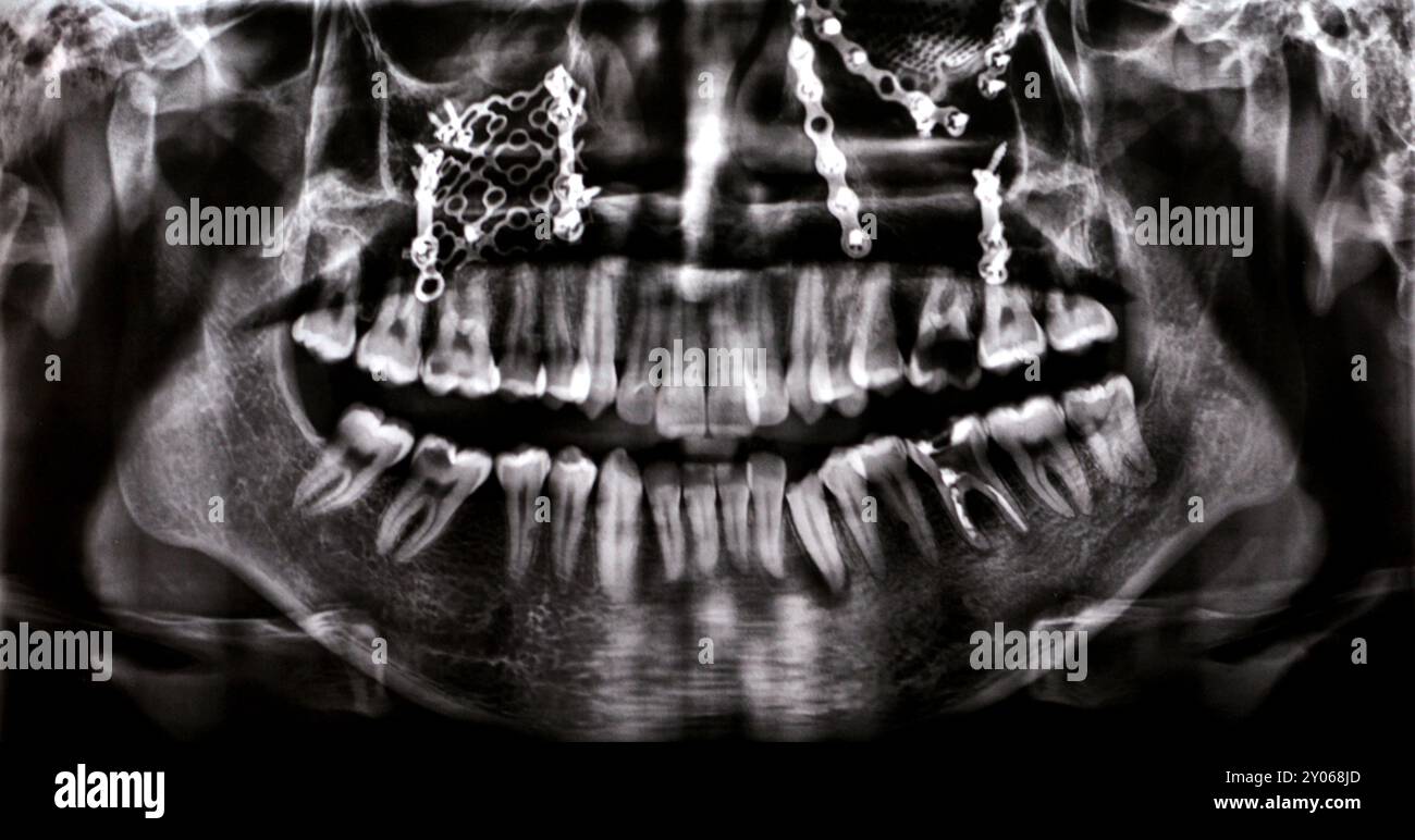 Panoramic X Ray shows multiple plates, screws for maxillary fixation of a fractured maxilla, titanium mesh on right side, decayed UL6, LL6 failed root Stock Photo