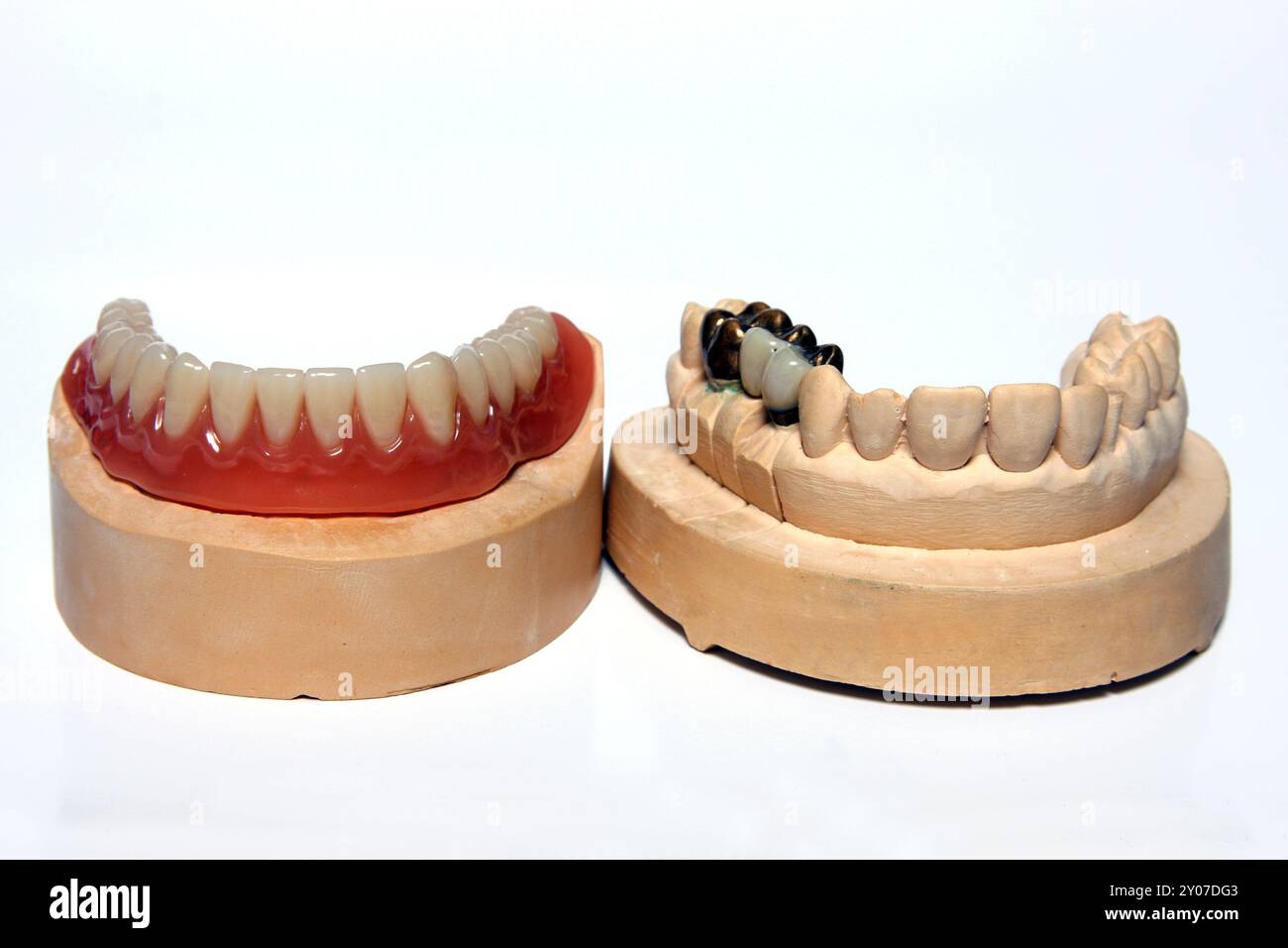 Cast teeth models hi-res stock photography and images - Alamy