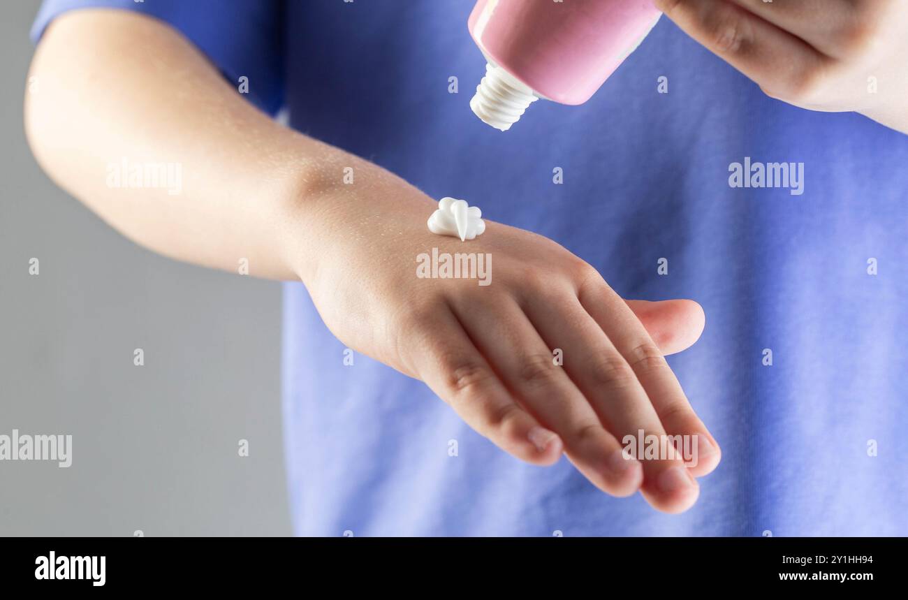 A girl applies medicinal cream to her hands for dermatitis and skin irritation. Dermatological cream for allergic reactions. Stock Photo