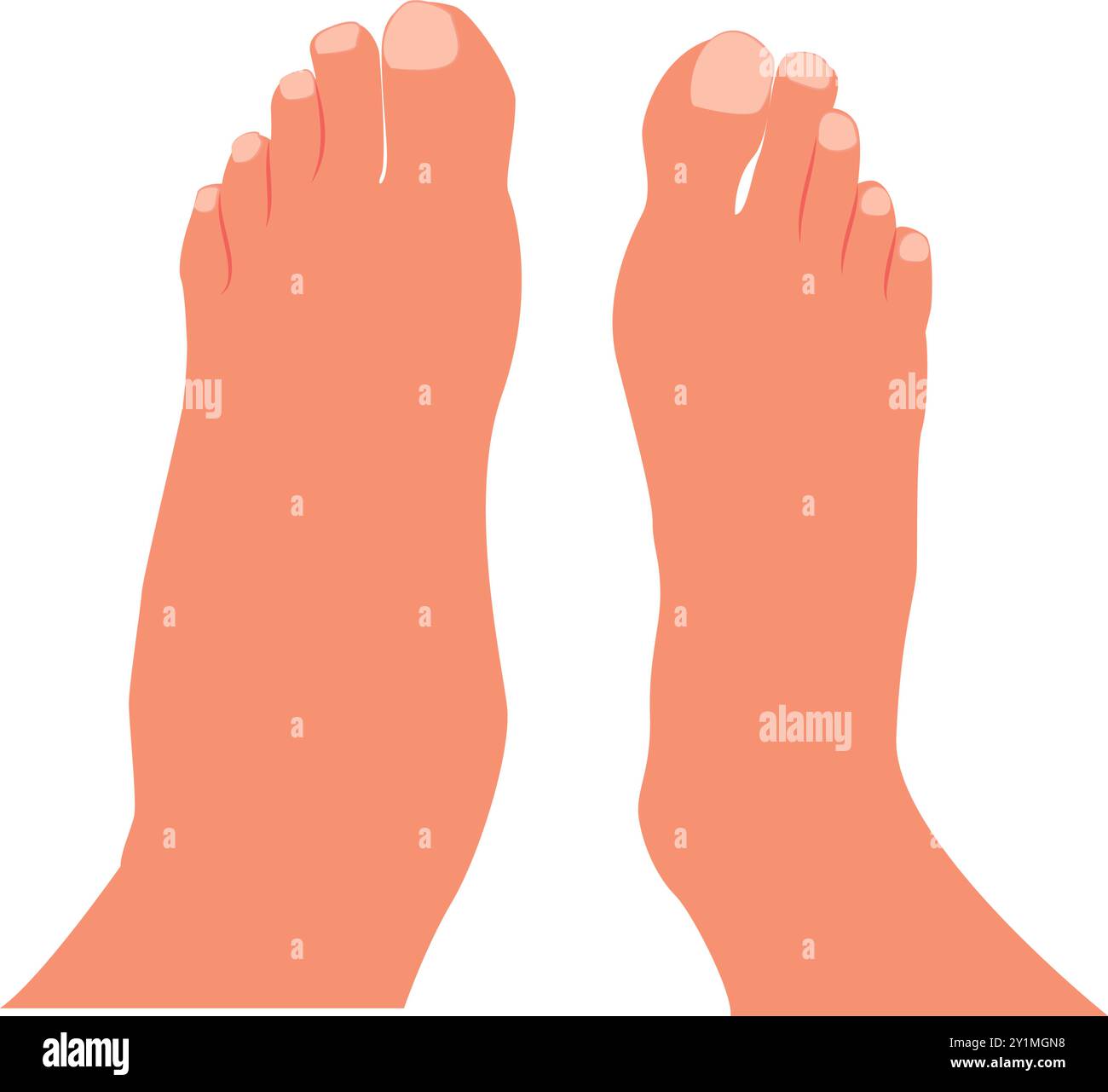 Swollen foot, normal foot. Before, after. Healthcare illustration. Vector illustration. Stock Vector