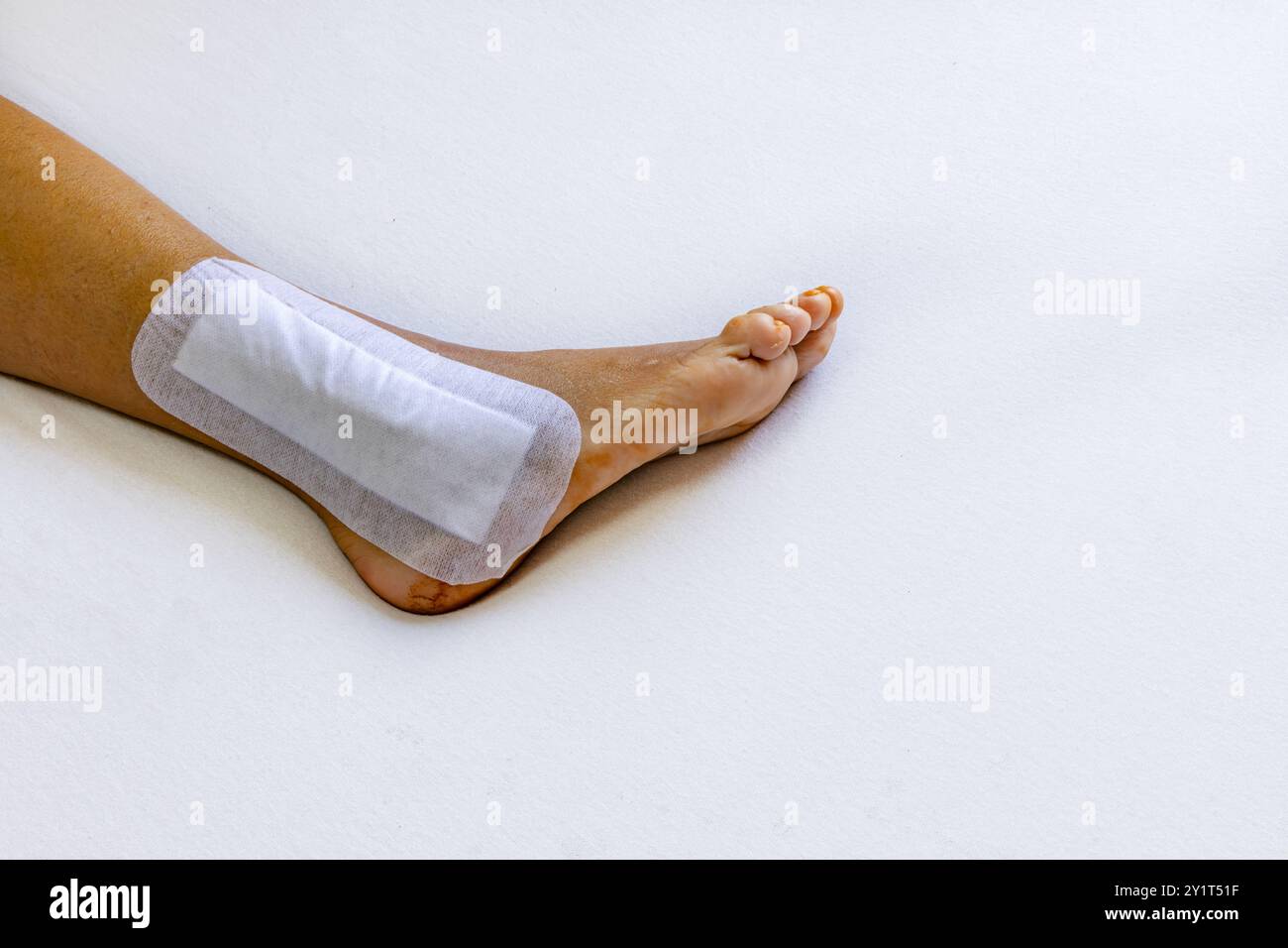 Right leg after surgery to repair a dislocated ankle joint and connect ...