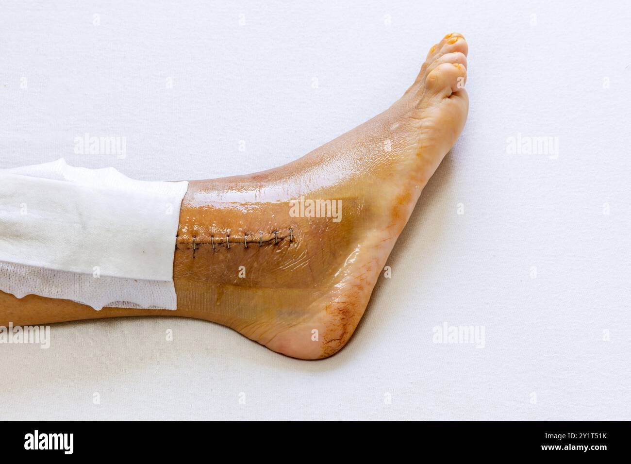 Right leg after surgery to repair a dislocated ankle joint and connect ...