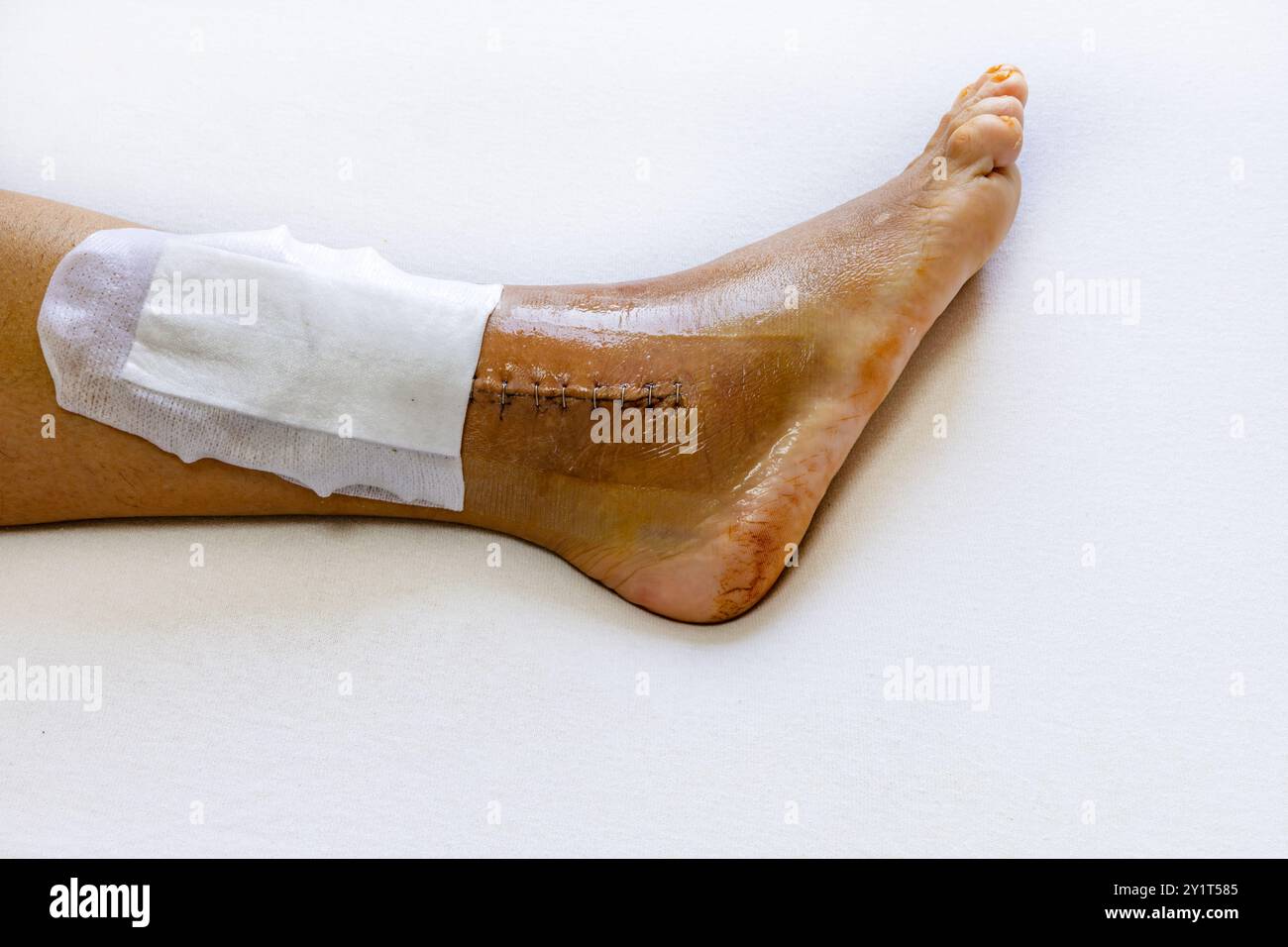 Right leg after surgery to repair a dislocated ankle joint and connect ...