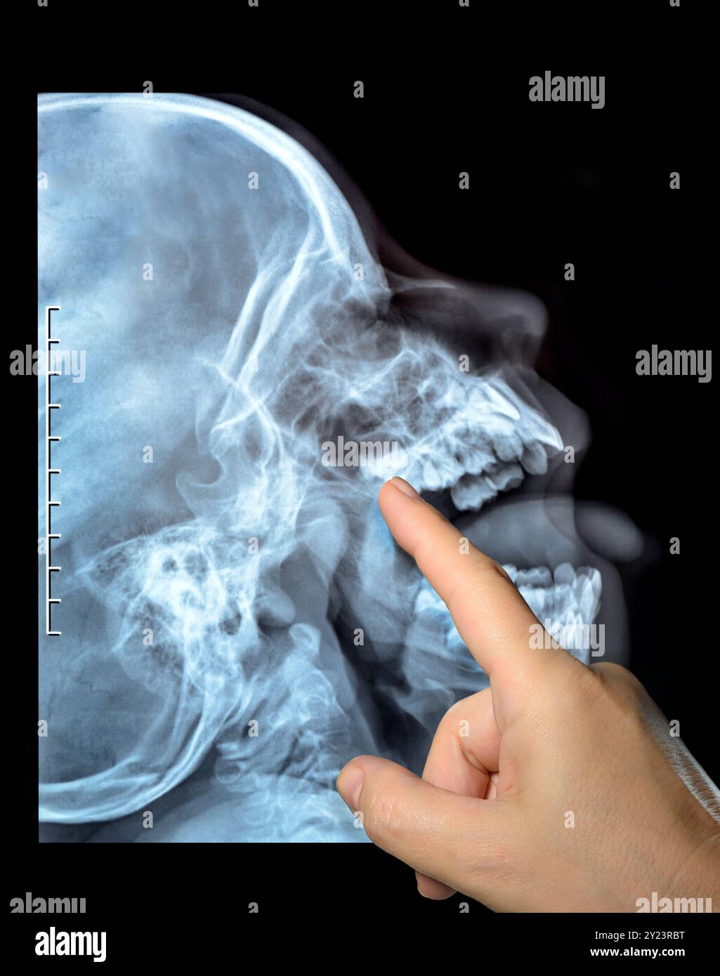 X-ray of a skull of the person. Radiography X ray dislocated jaw broken bones nasopharynx high quality hand finger points Stock Photo