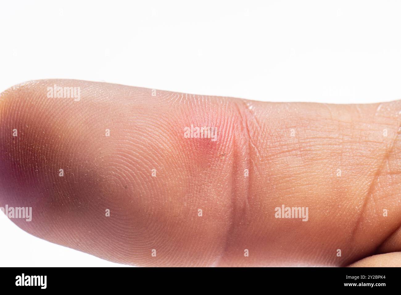 Finger bacteria infection hi-res stock photography and images - Alamy
