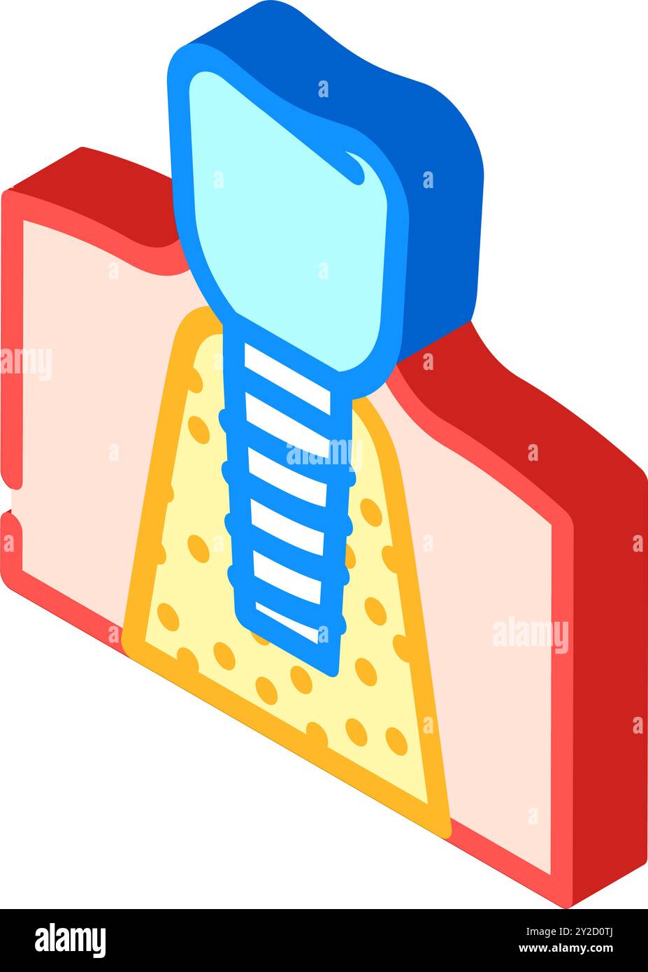 dental implant surgery surgery isometric icon vector illustration Stock ...