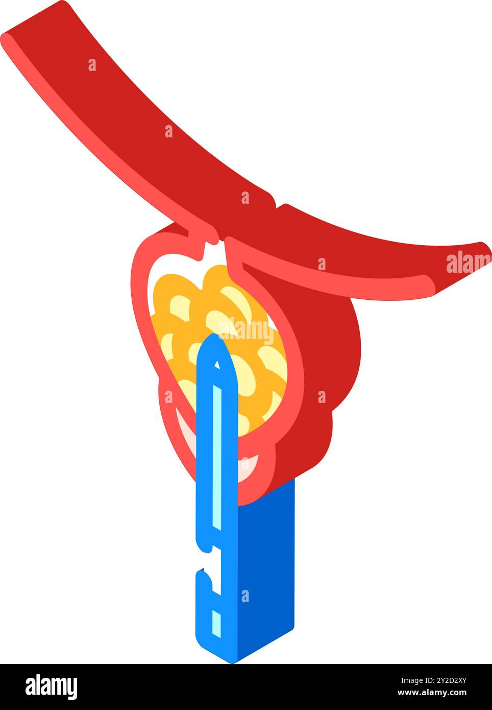 transurethral resection prostate surgery isometric icon vector ...