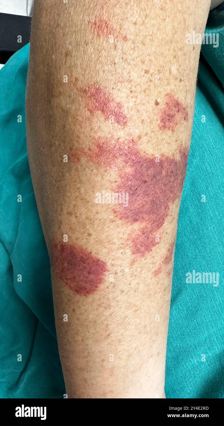 Port wine stain on a patient's arm. Port wine stains are a type of naevus, or birthmark, caused by expanded blood vessels just under the skin. Stock Photo