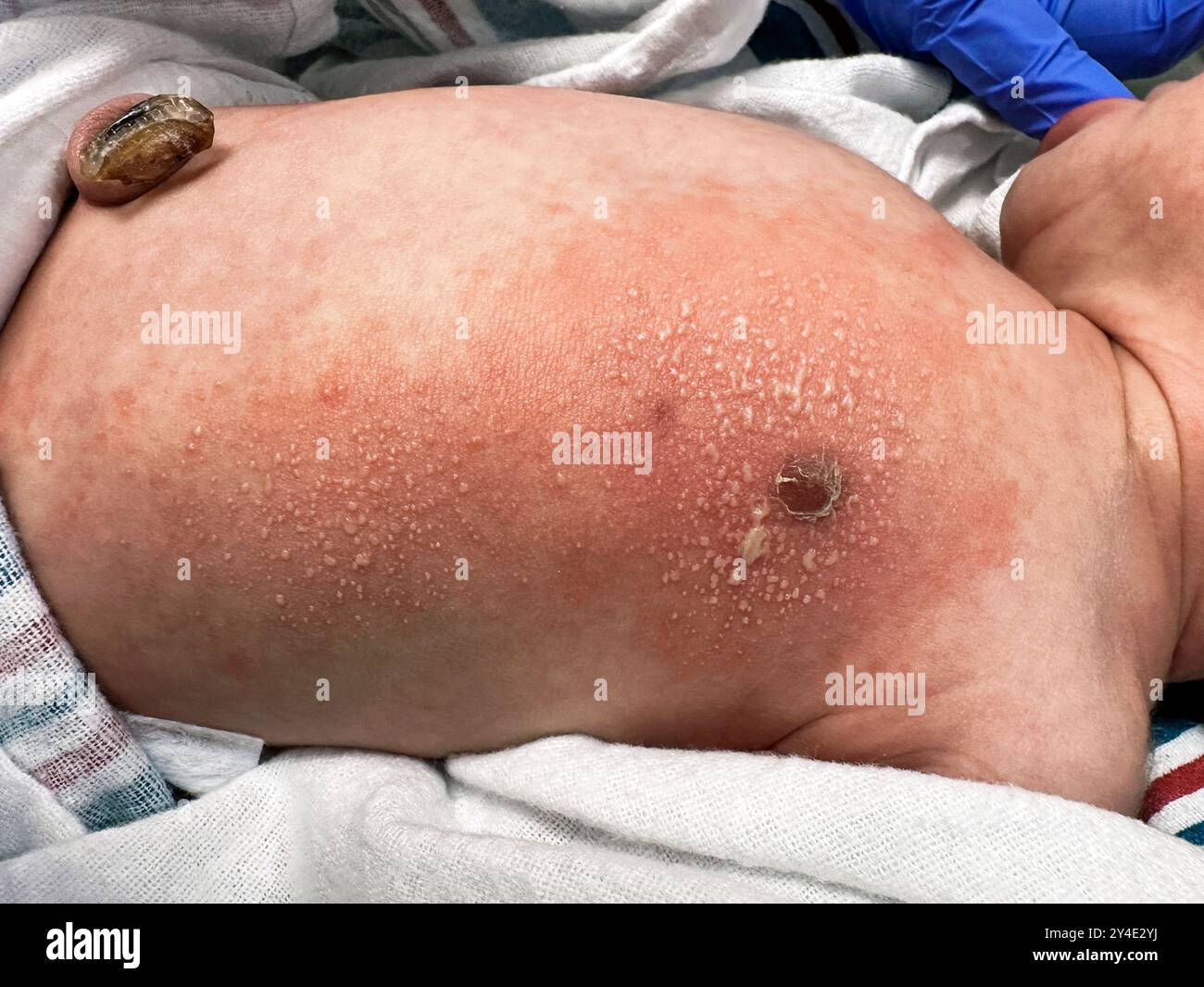 Rash on child's chest: Types, symptoms, and treatments, image size:1300x1065