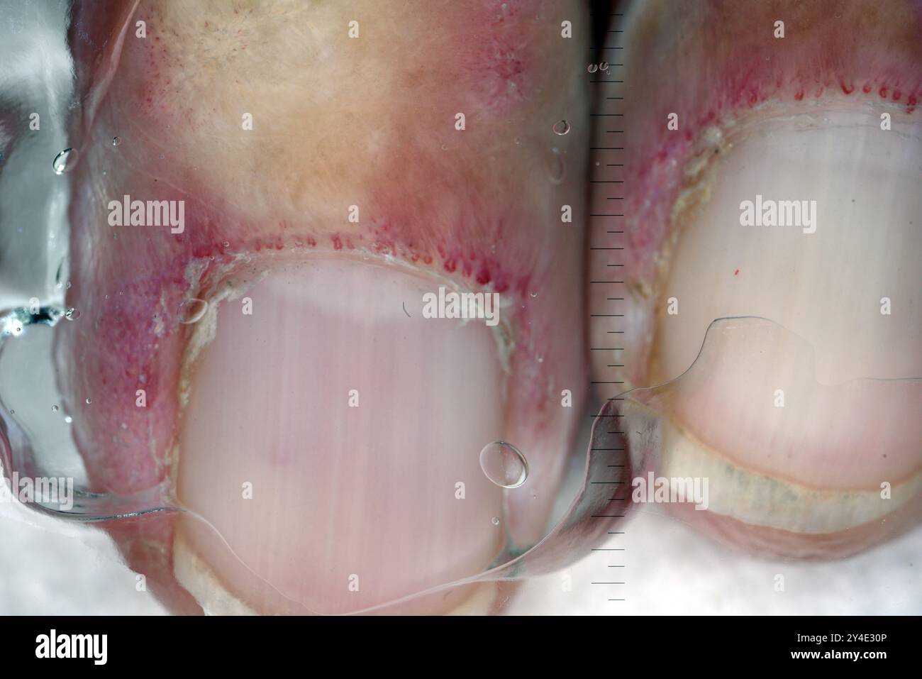 Dermatoscope image of dermatomyositis of the cuticles. Dermatomyositis ...