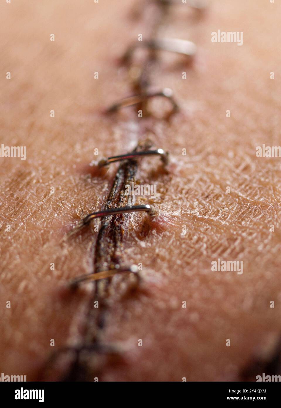 Closeup of medical staples helping a surgical incision and scar heal after an organ transplant operation Stock Photo