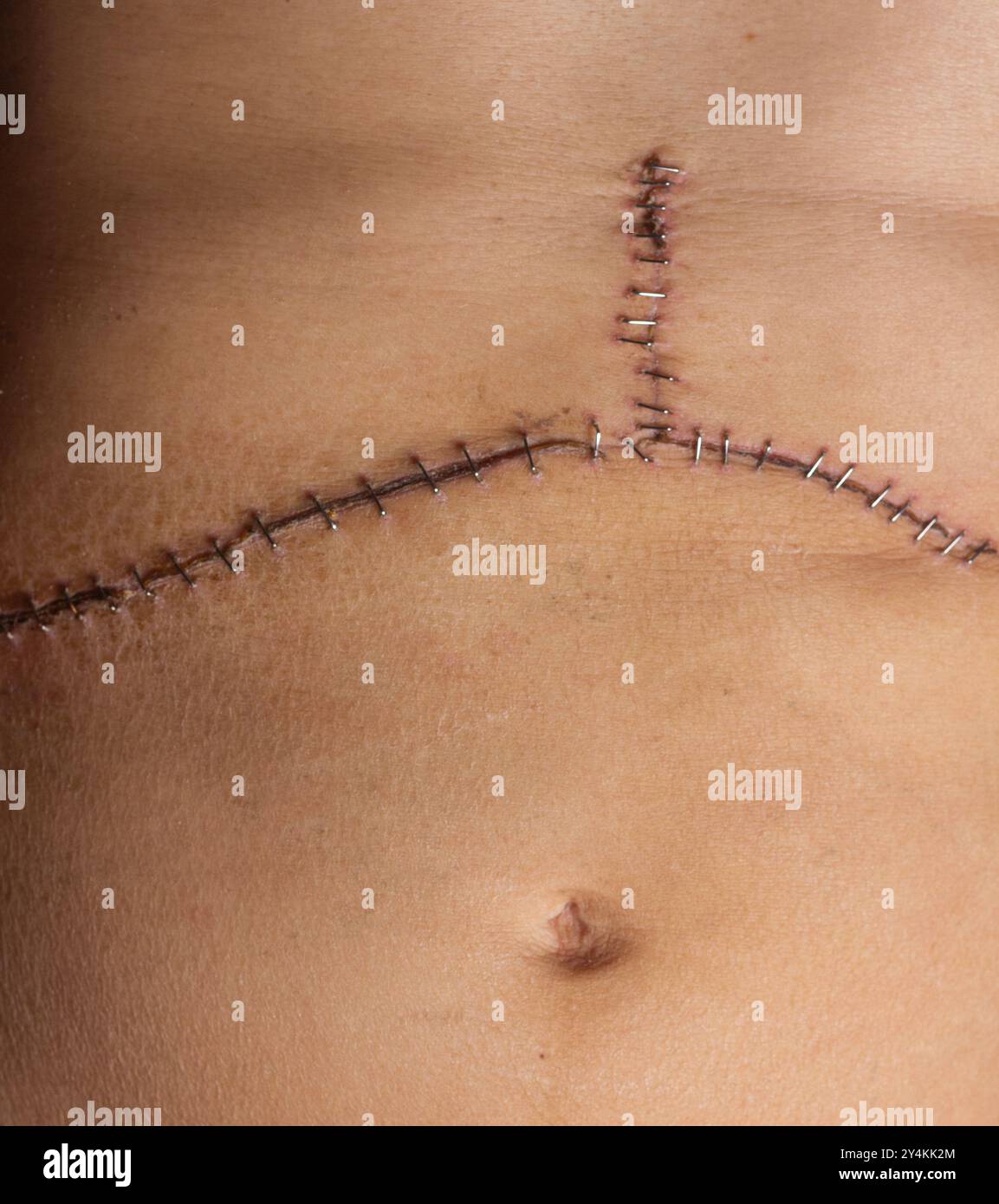 Closeup of medical staples helping a surgical incision and scar heal after an organ transplant operation Stock Photo