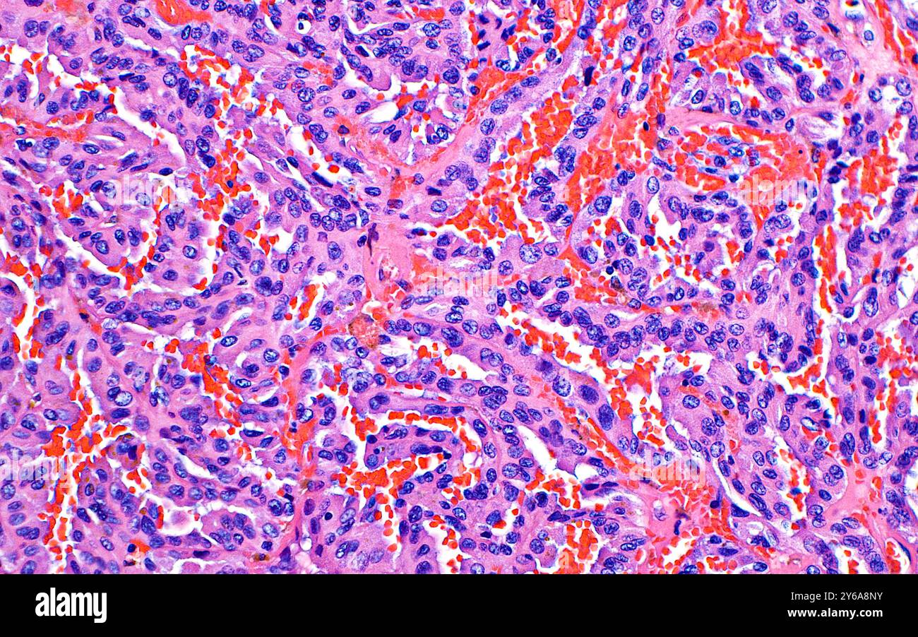 Light micrograph of papillary renal cell carcinoma. Papillary carcinoma ...