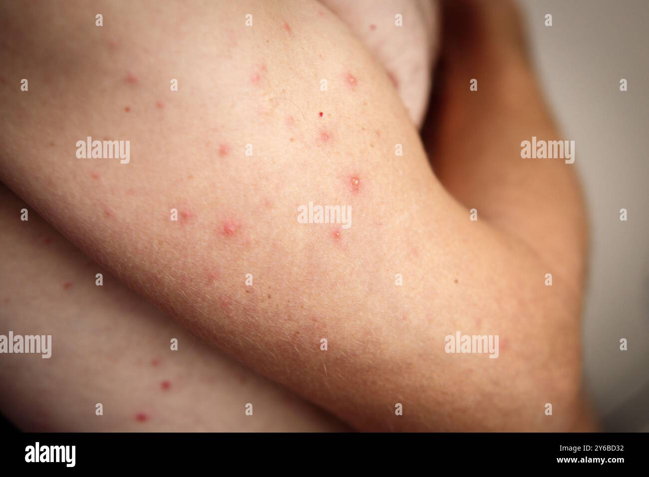The first rash on the body of an adult man after contracting chickenpox ...