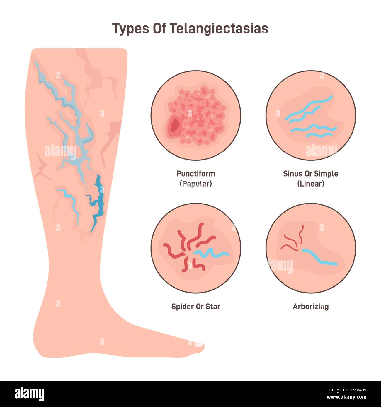 Telangiectasia types set. Varicose veins pattern, dilated blood vessels ...