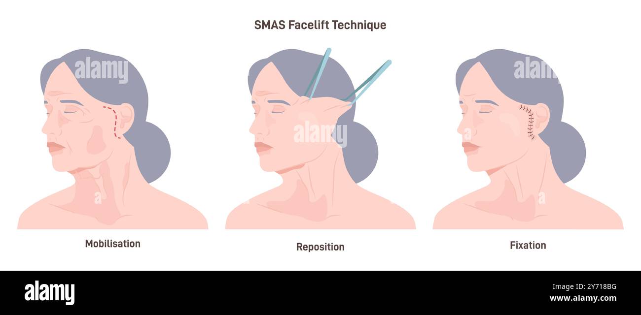 SMAS facelift surgery. Face features correction or anti-aging procedure ...