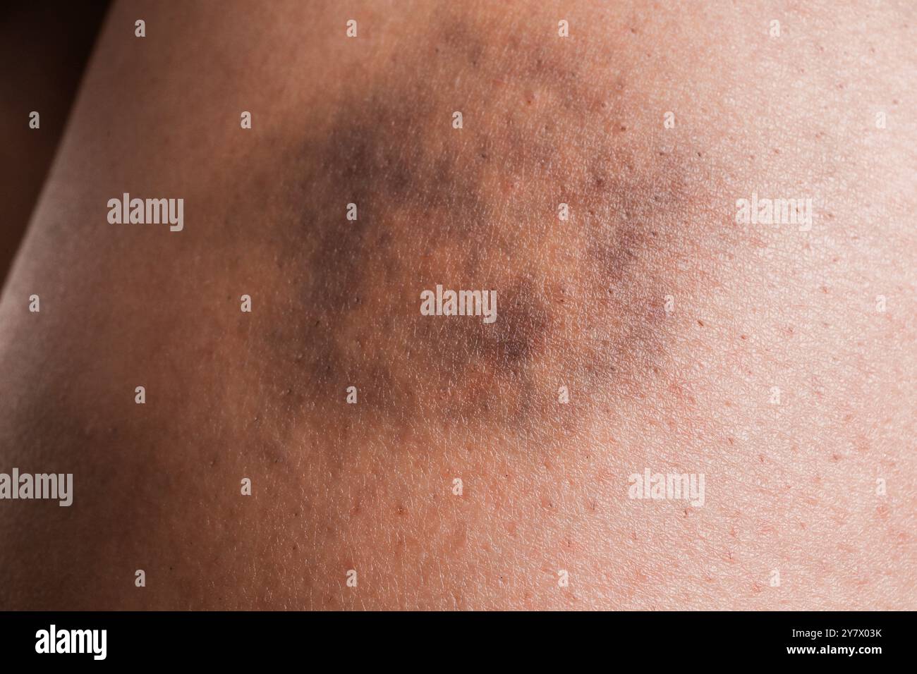 Closeup view of woman with bruise on leg Stock Photo