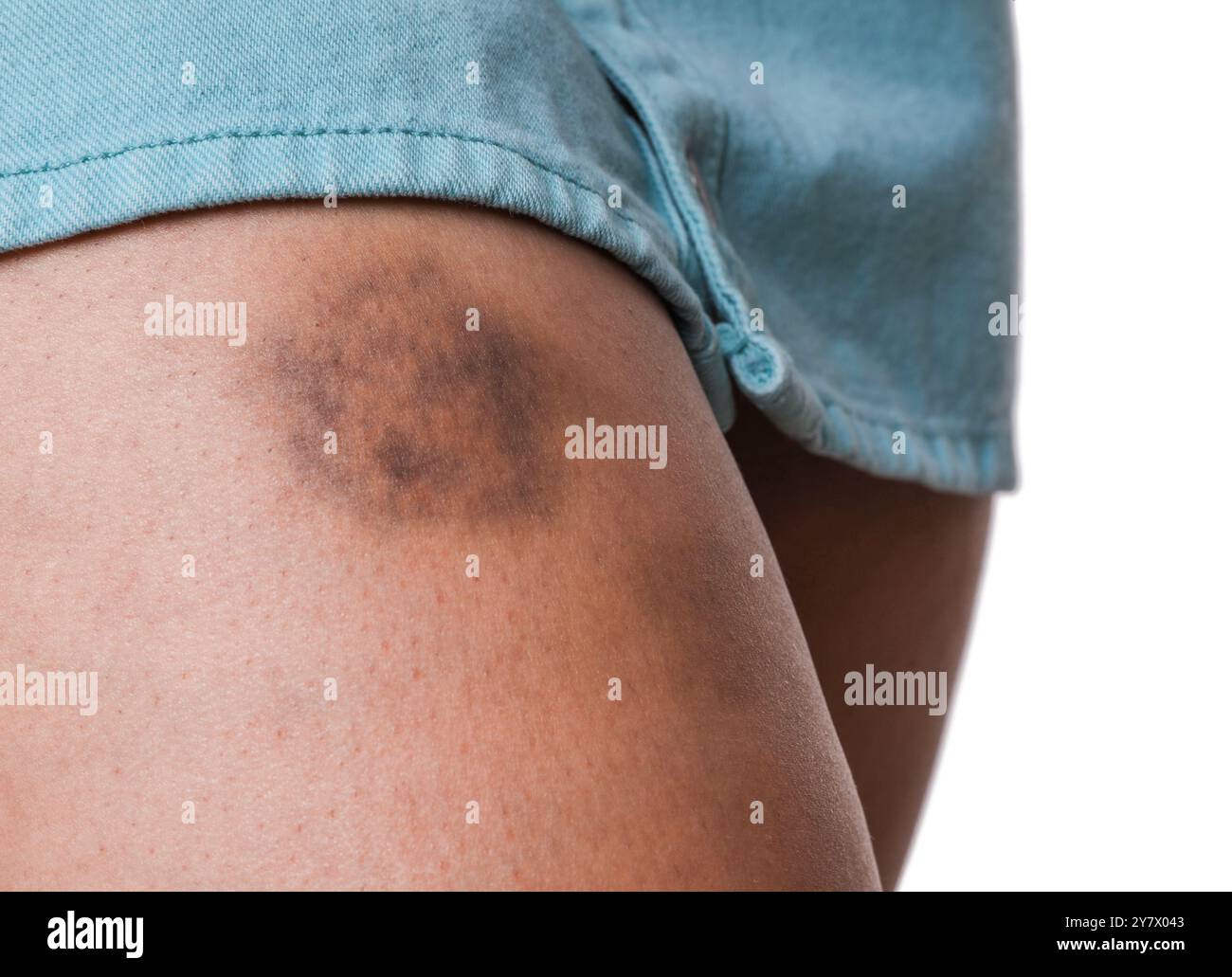 Woman with bruise on leg against white background, closeup Stock Photo