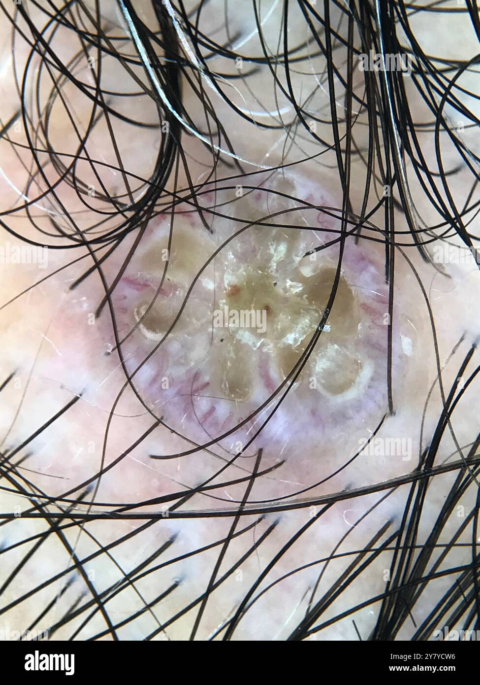 Dermatoscope image of bowen s disease on the hairline of a hispanic