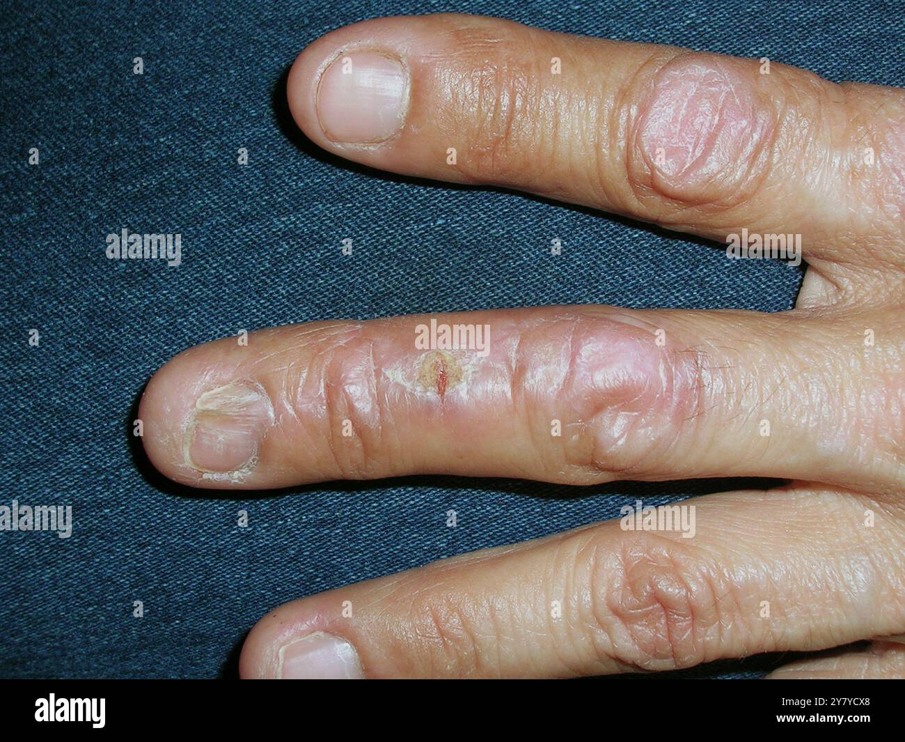 linear-lichen-planus-lichen-planus-is-an-inflammatory-disorder-of-the