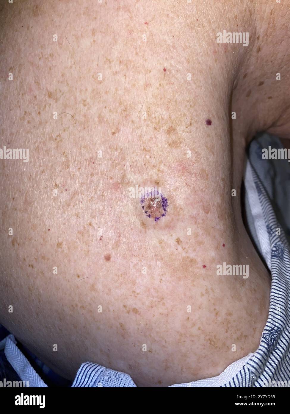 Melanoma on the right shoulder of a 70 year old caucasian female ...