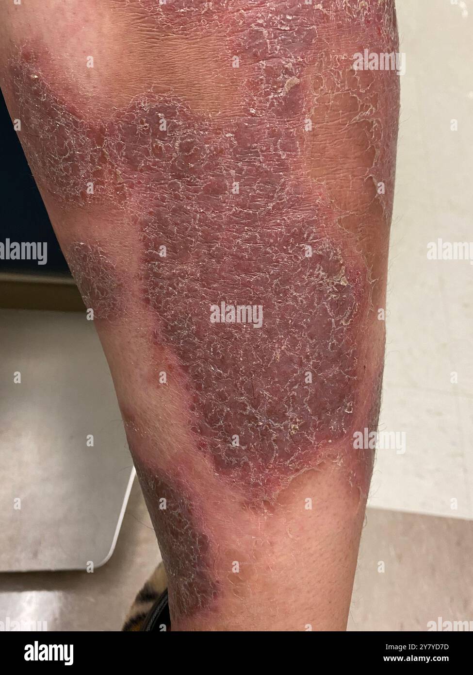Psoriasis on the leg of a Hispanic female patient. Psoriasis is a skin ...