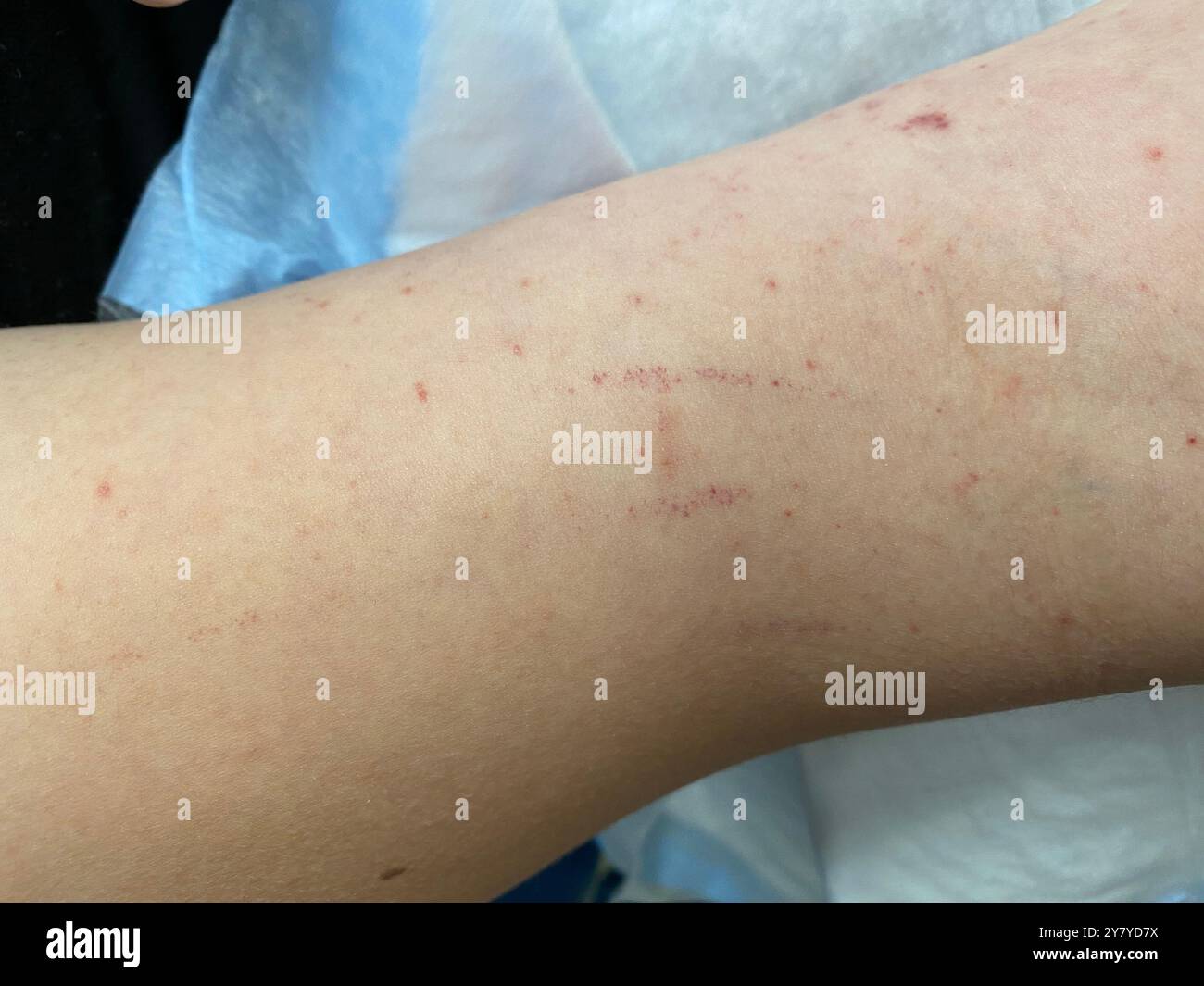 Pityriasis lichenoides chronica lesions on the arm of an 18 year old ...