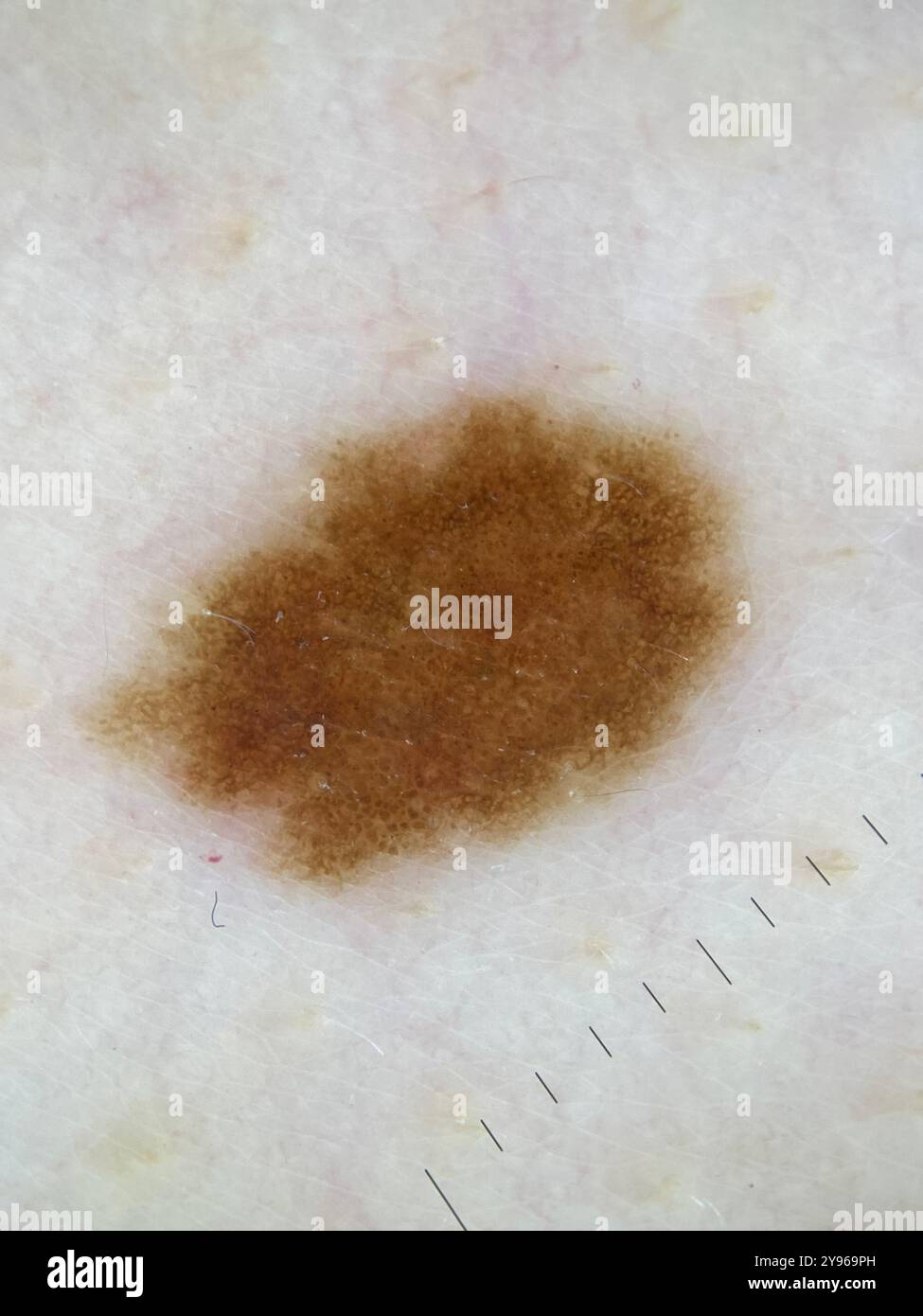 dermatoscope-image-of-an-atypical-mole-atypical-moles-are-unusual-but