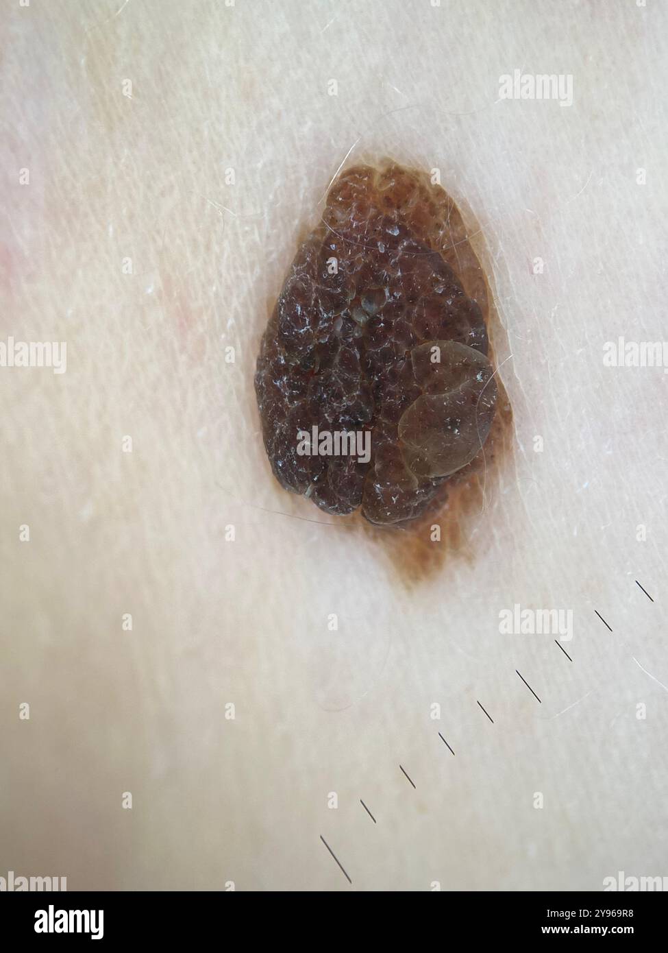 dermatoscope-image-of-an-atypical-mole-atypical-moles-are-unusual-but