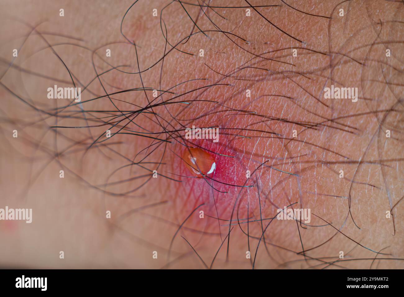 Hair follicle infection hi-res stock photography and images - Alamy, image size:1300x956