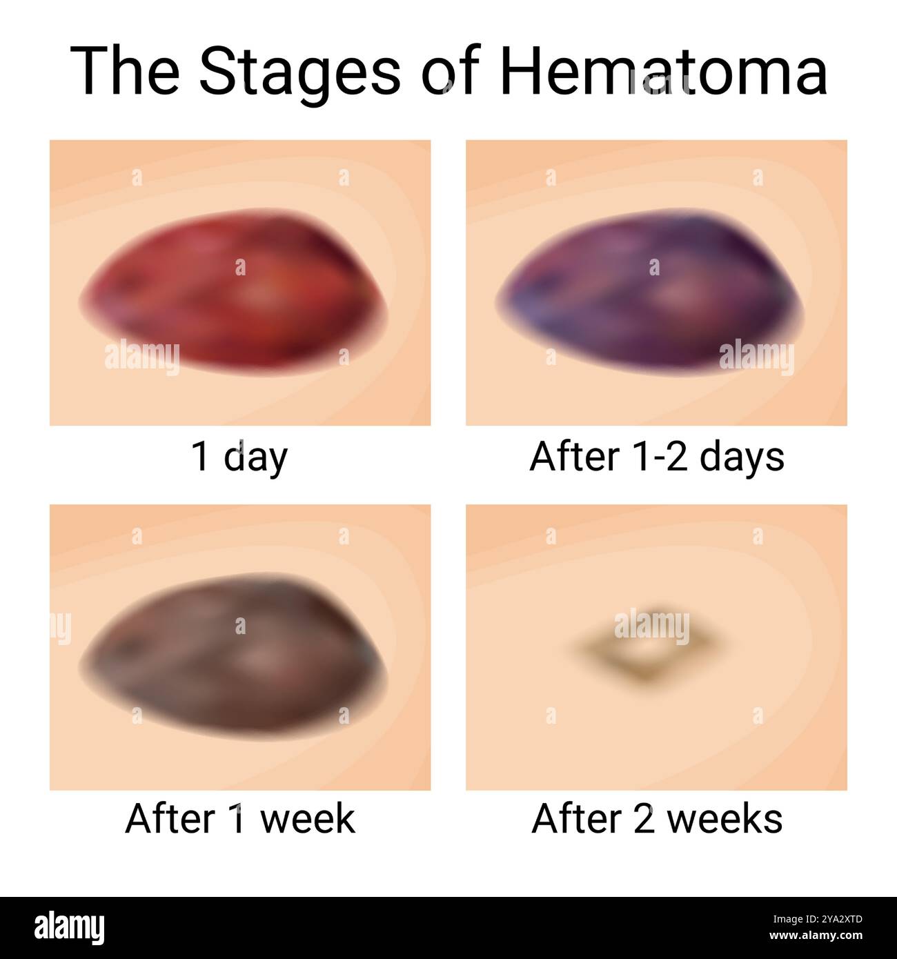Healing Stages of Bruises and Hematomas Stock Vector Image & Art - Alamy