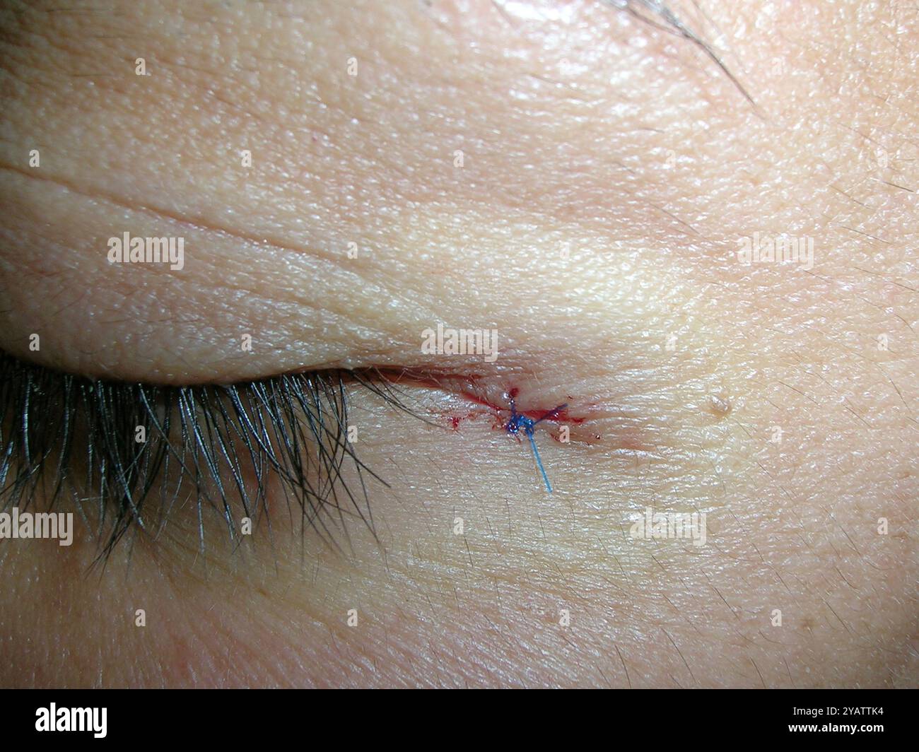 Hidrocystoma Excision Stitched Wound After The Removal Of A hidrocystoma-excision-stitched-wound-after-the-removal-of-a